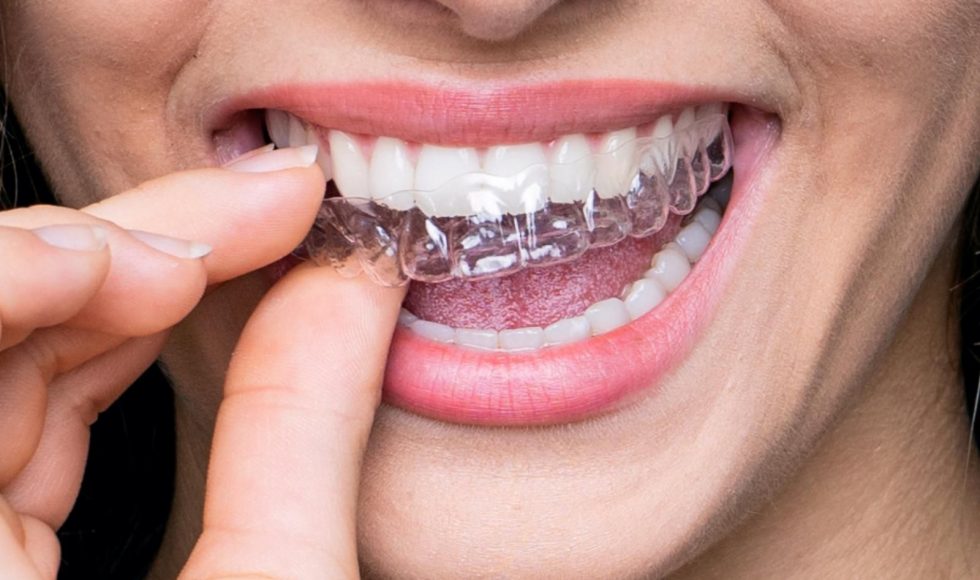 Orthodontics braces and aligners with Dr. Ali - Braces