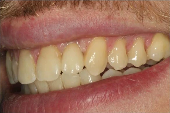 Single tooth implant case and final crown - Final