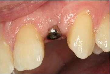 Single tooth implant case and final crown - Initial