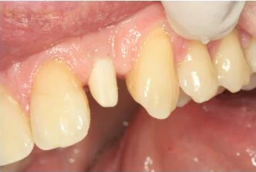 Single tooth implant case and final crown - Planning