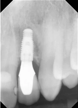 Single tooth implant case and final crown - X-ray