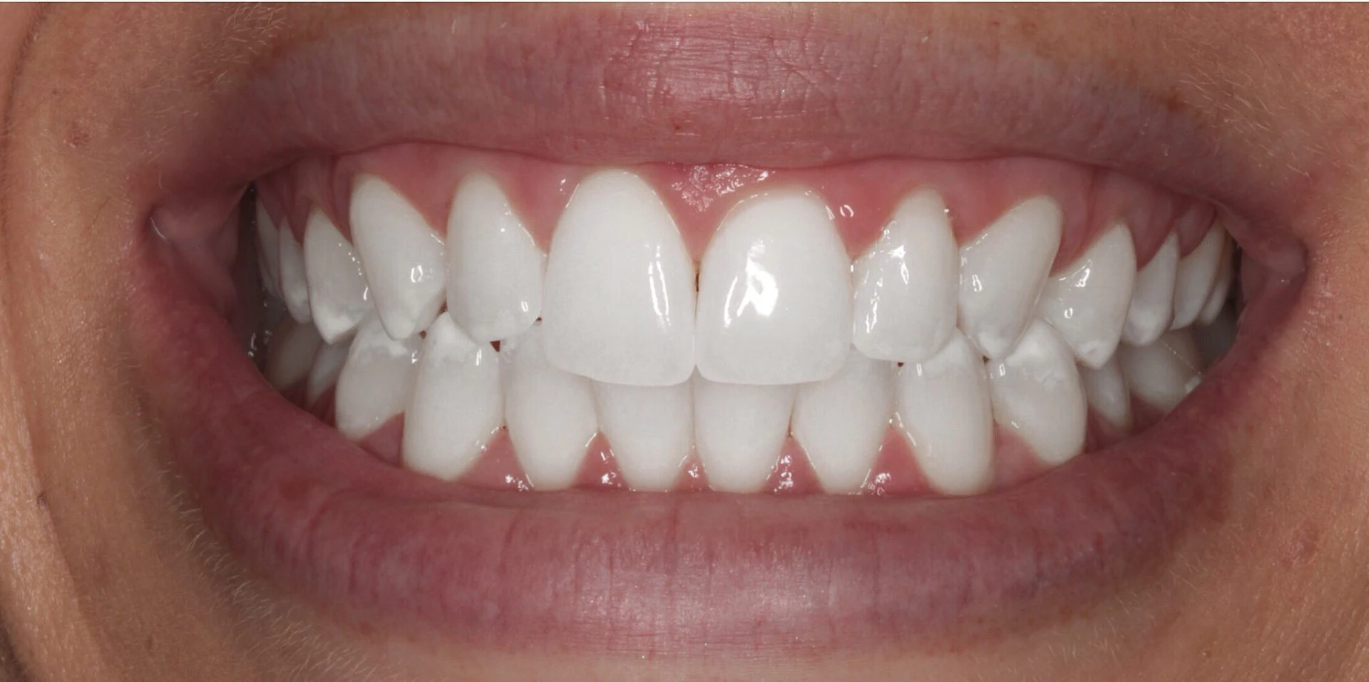 Teeth whitening before and after with Dr. Ali - After