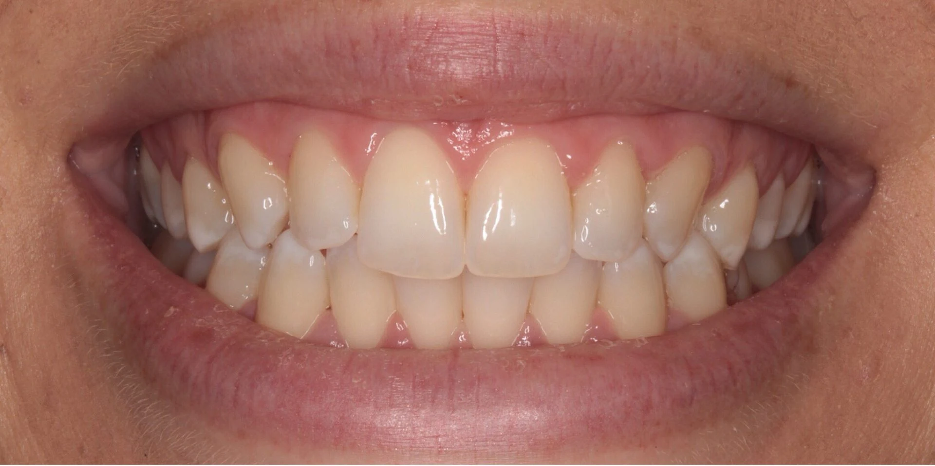 Teeth whitening before and after with Dr. Ali - Before