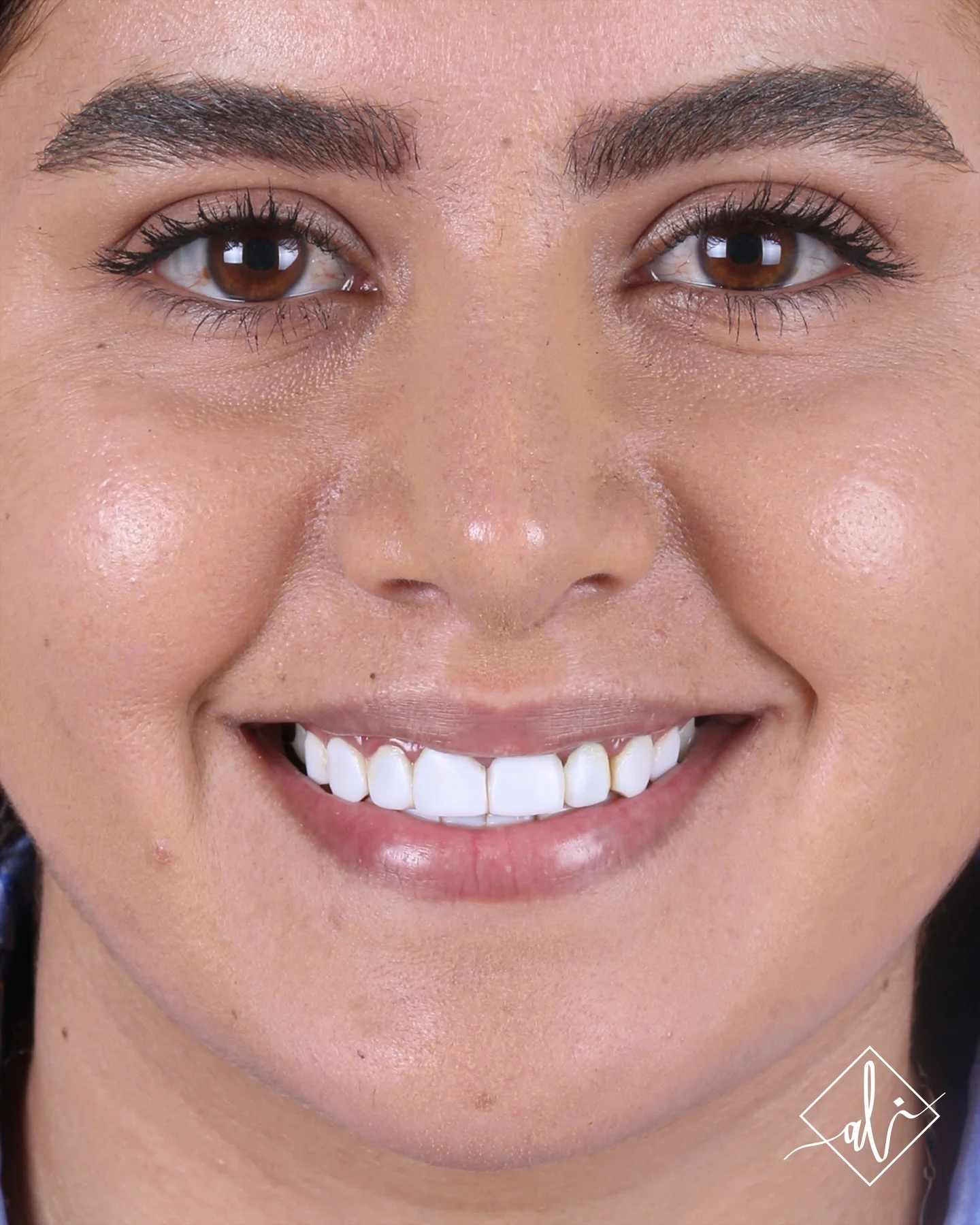 Dental veneers before and after case with Dr. Ali - Before