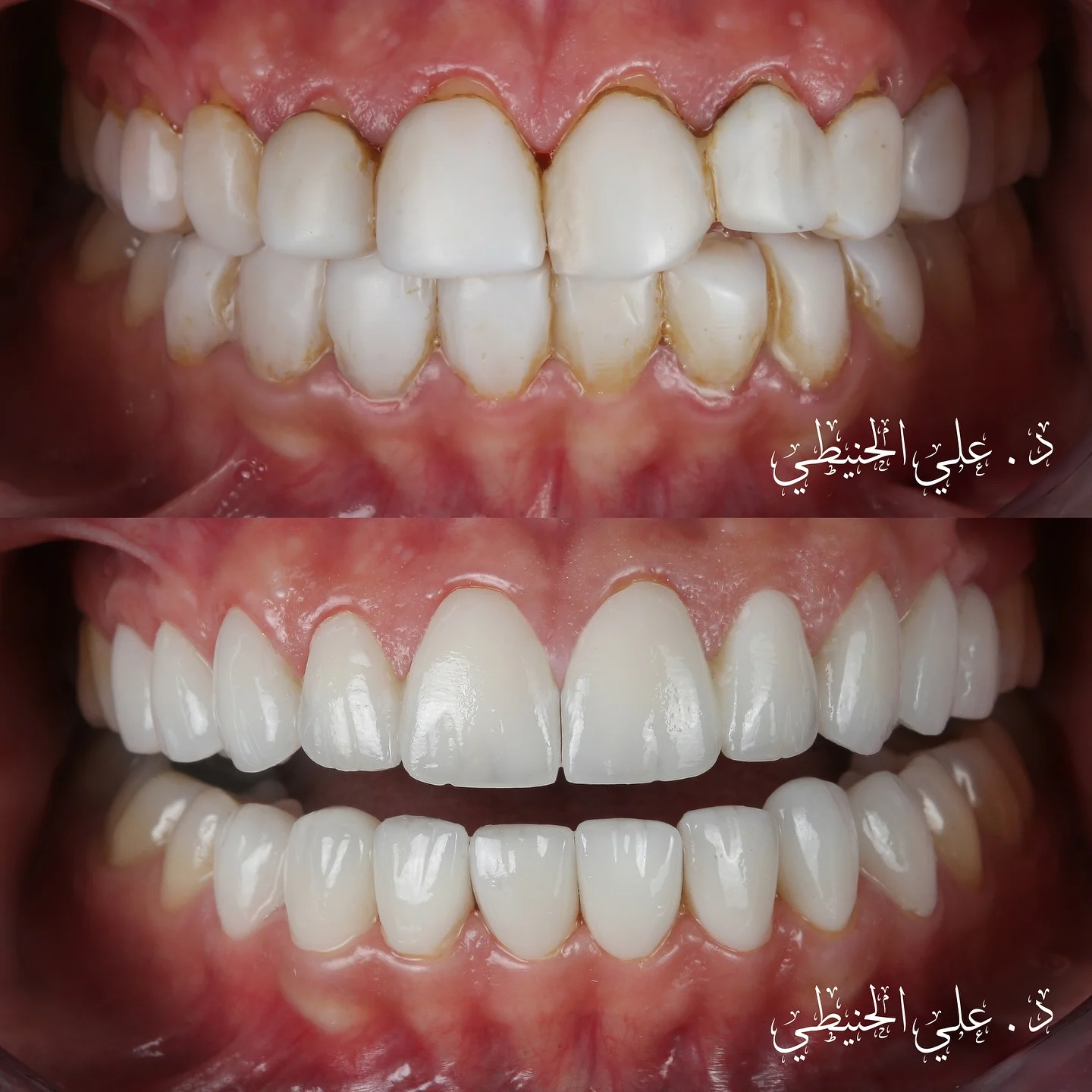 Natural looking veneers in Jordan close up