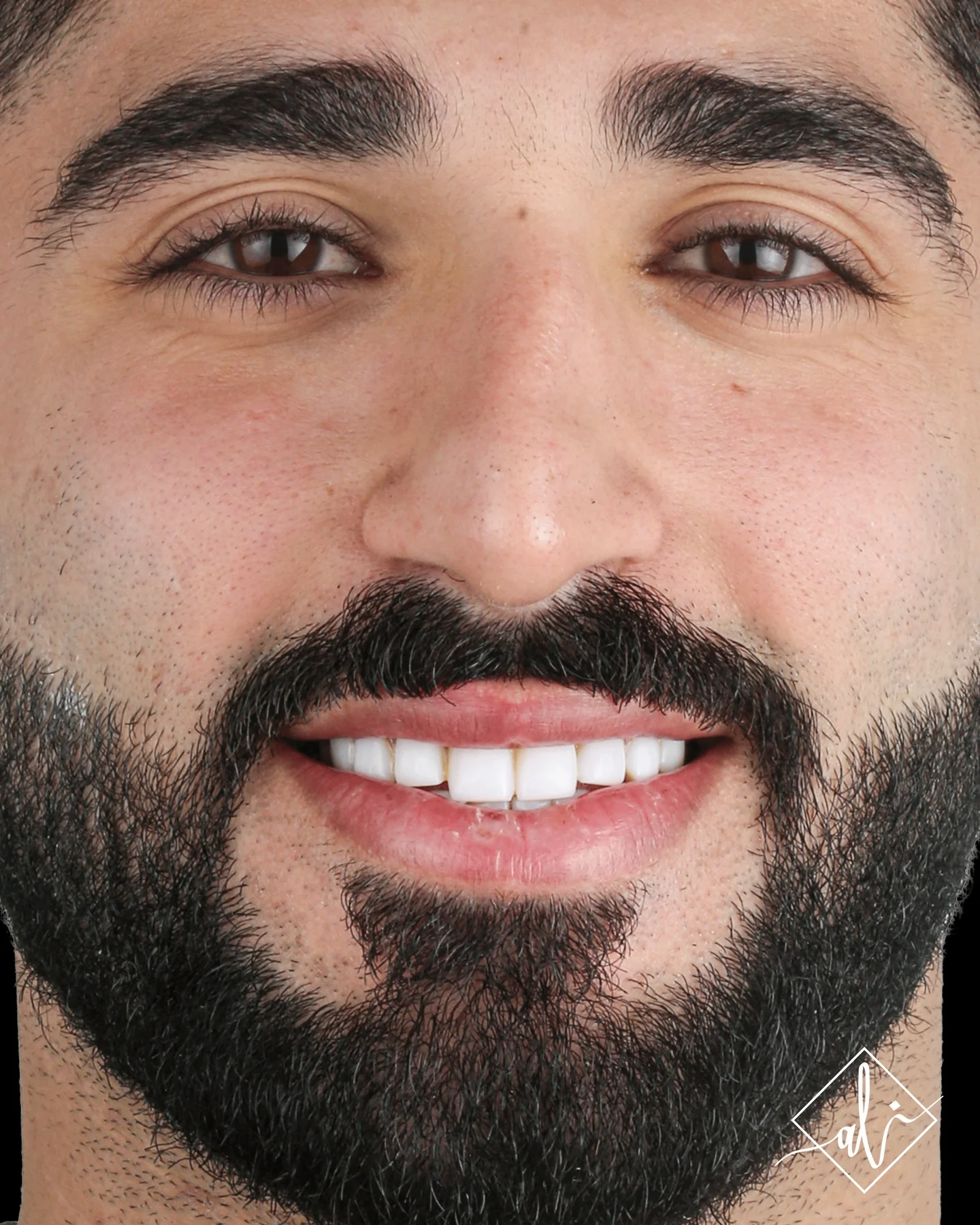 Smile shape enhancement before and after - Before