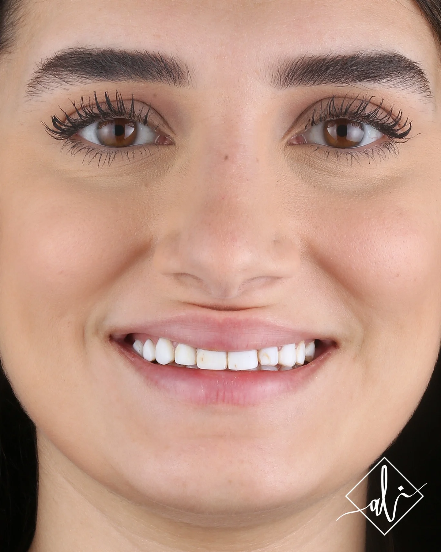Zircon veneer result before and after - Before