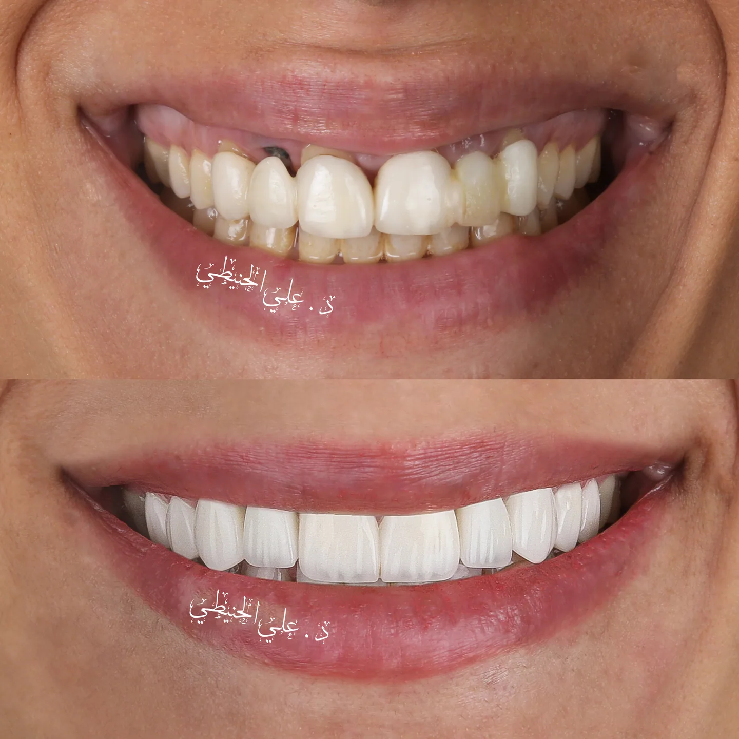 Natural veneers smile transformation in Jordan