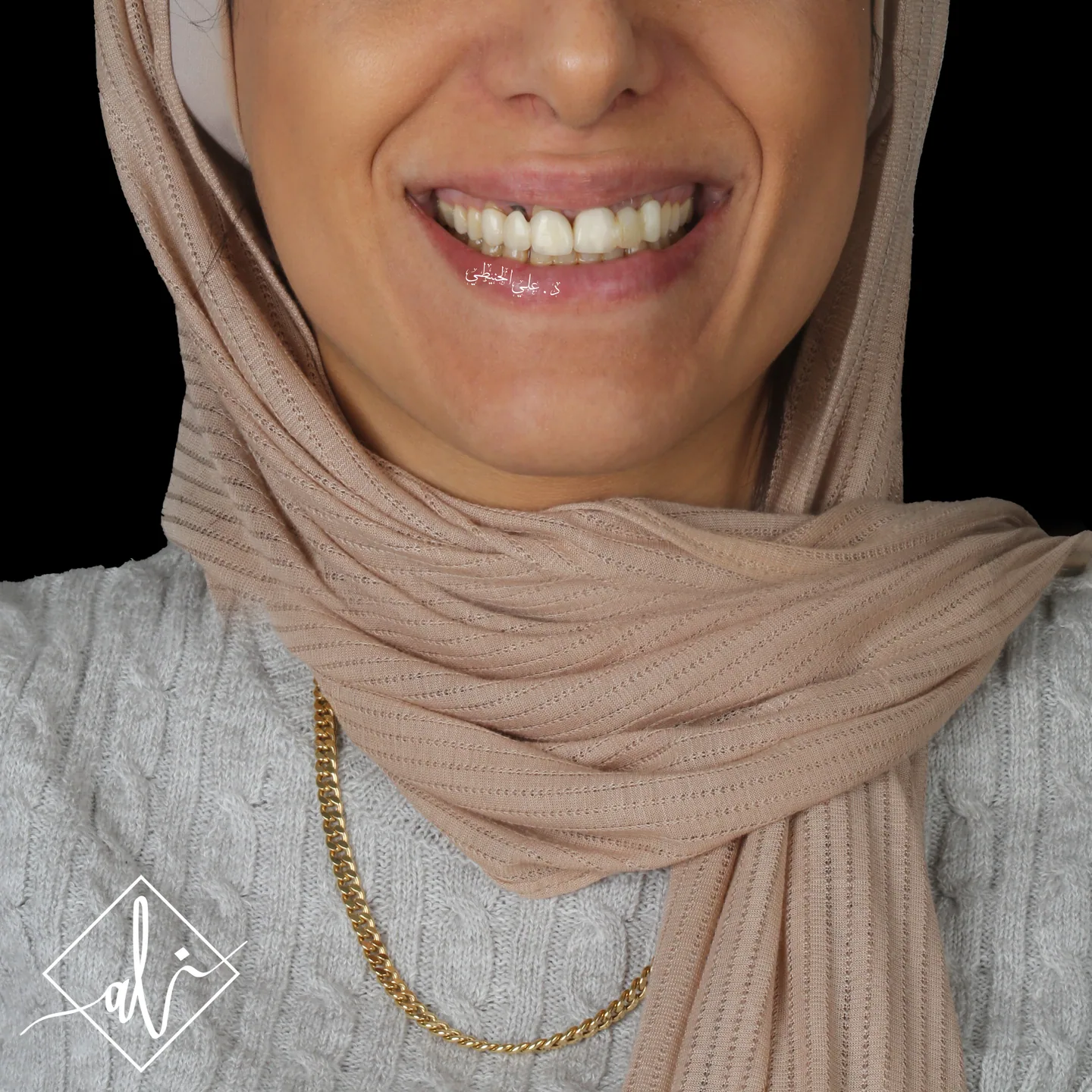 Natural veneers smile transformation in Jordan 2