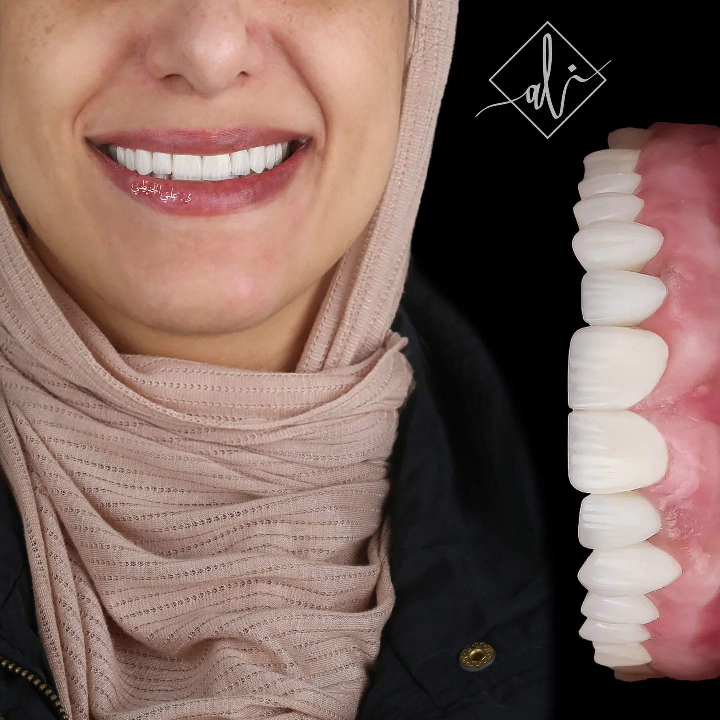 Natural veneers smile transformation in Jordan 3