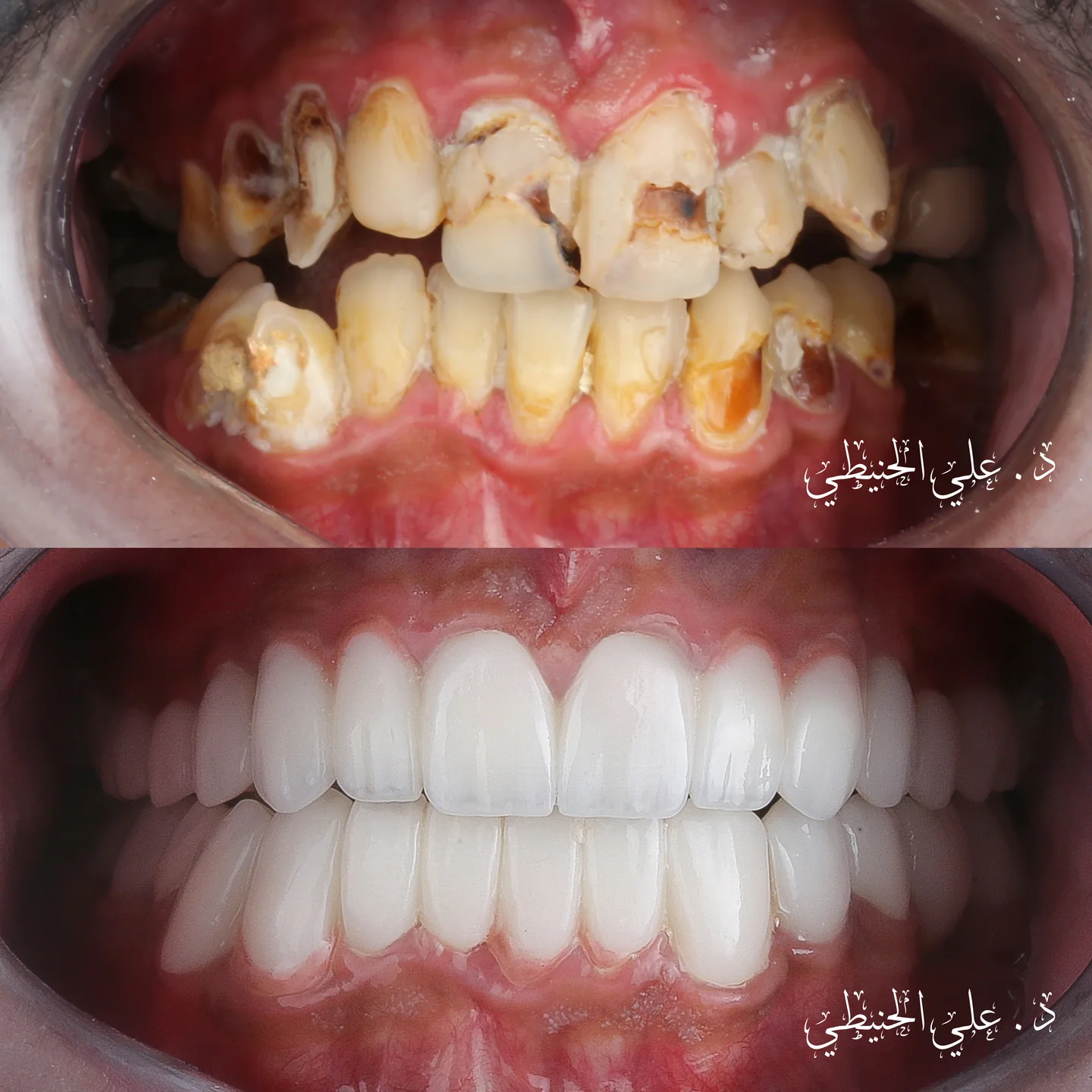 Hollywood Smile before and after result in Amman 1