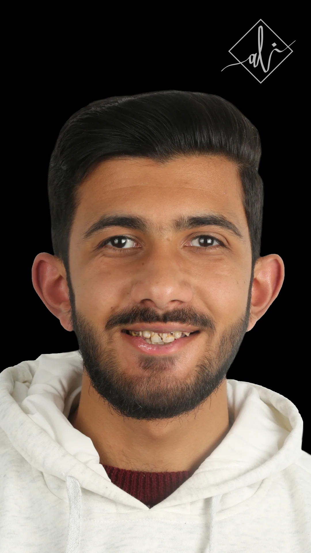 Hollywood Smile before and after result in Amman 2