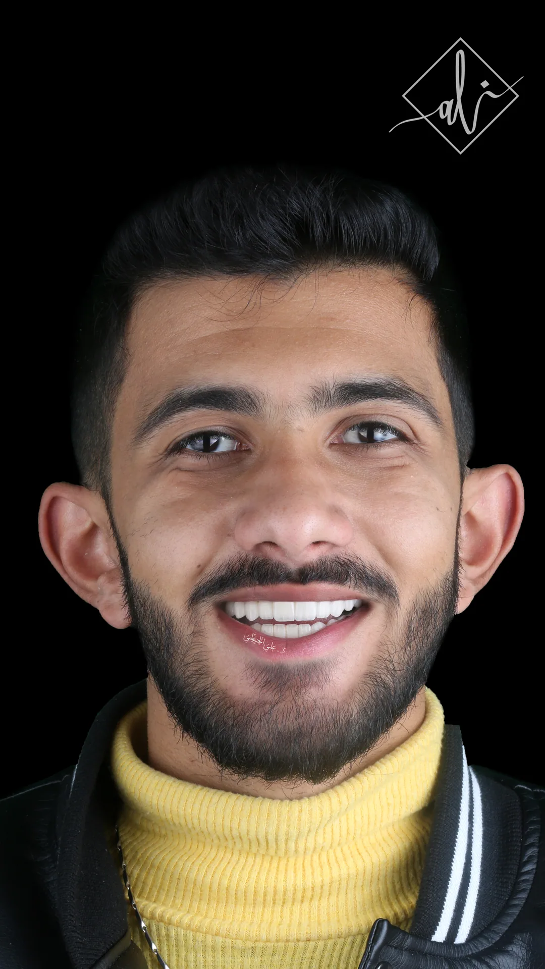 Hollywood Smile before and after result in Amman 3