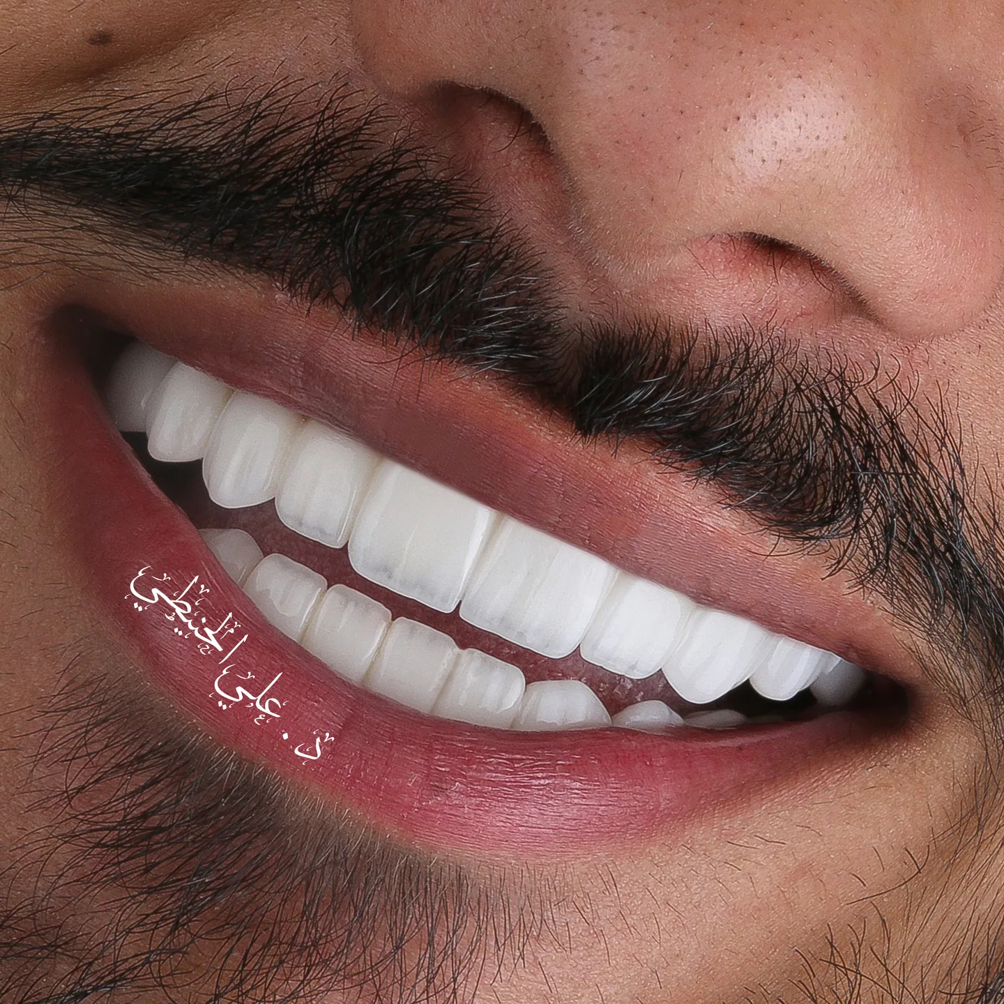 Hollywood Smile before and after result in Amman 4
