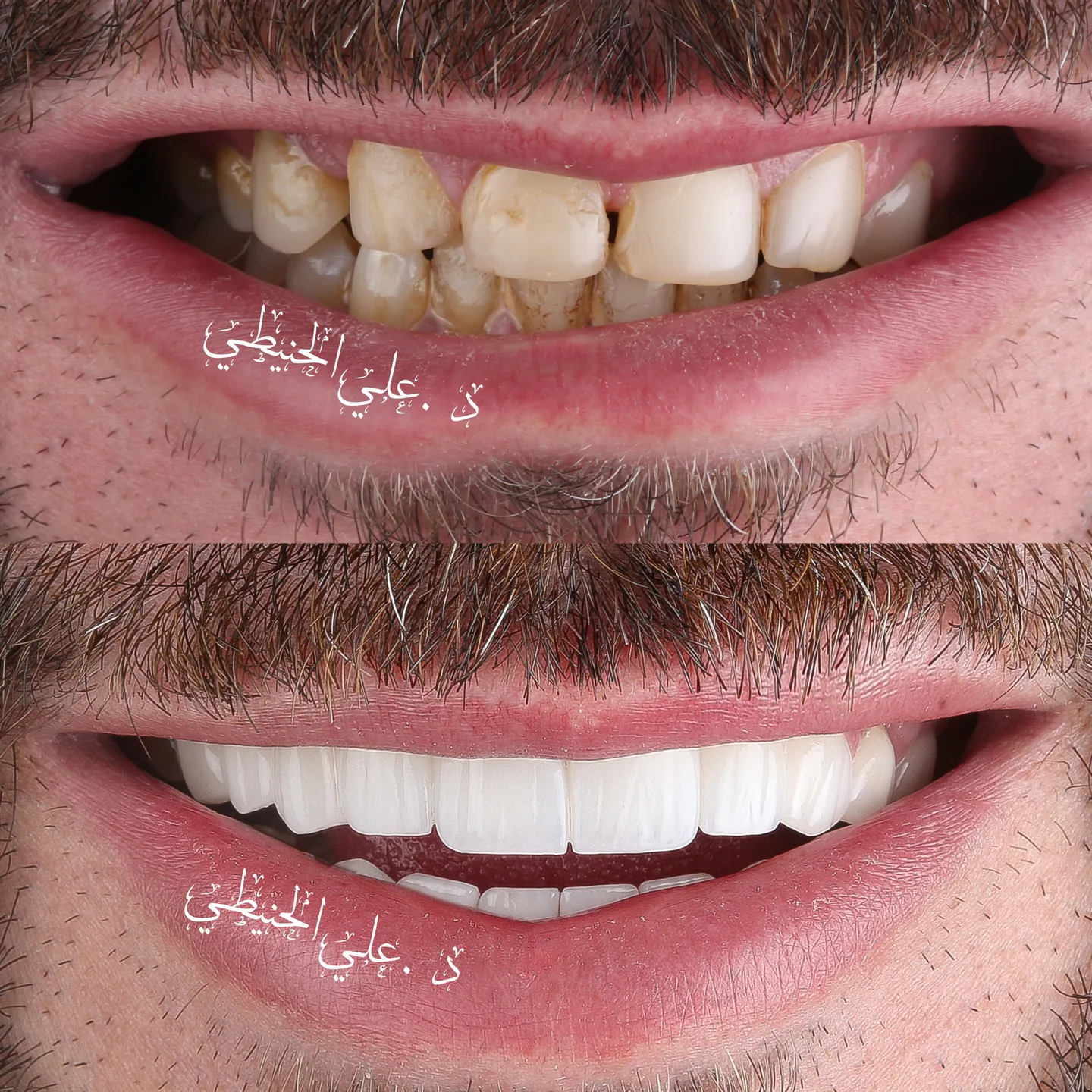 Dental veneers before and after smile result in Jordan 1