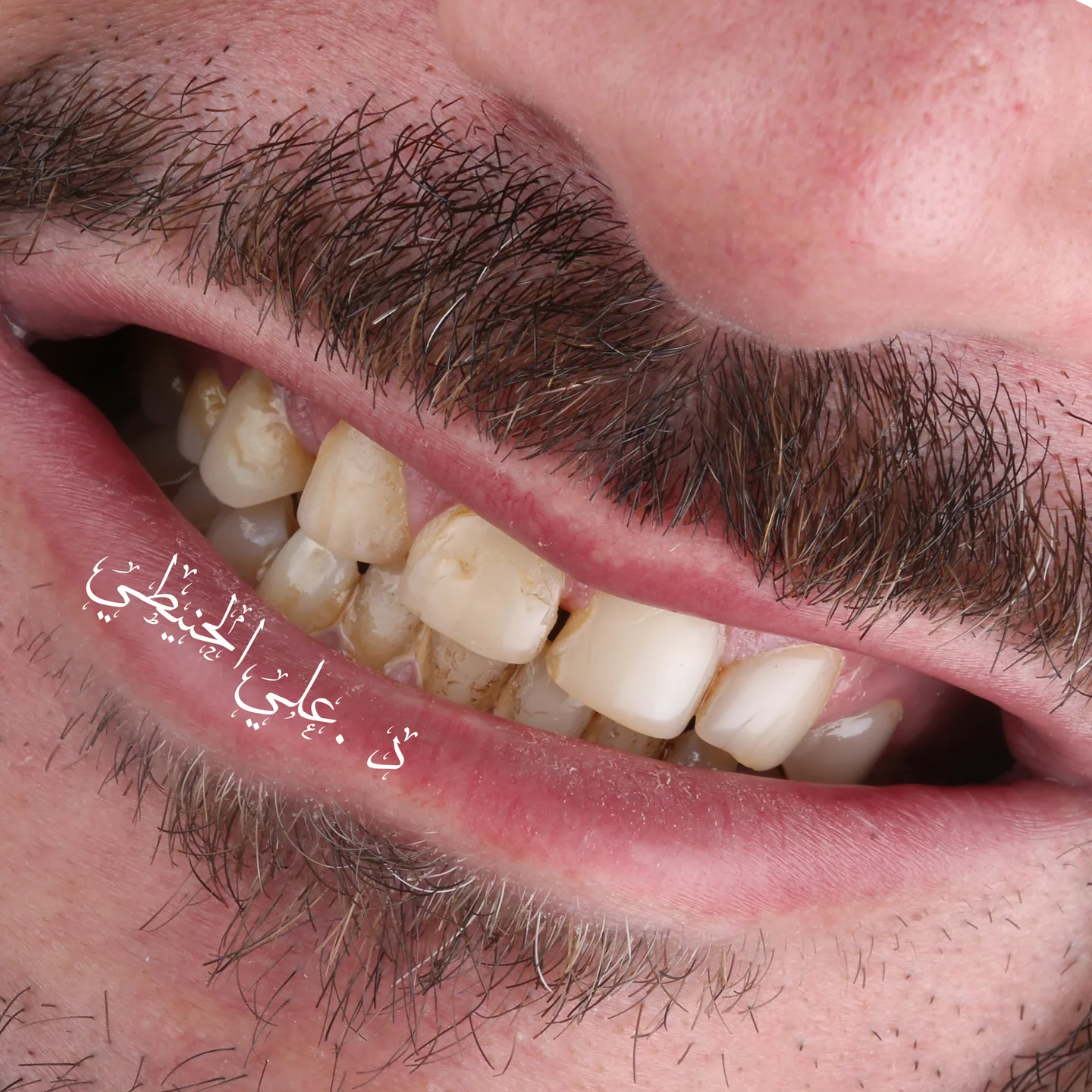 Dental veneers before and after smile result in Jordan 2