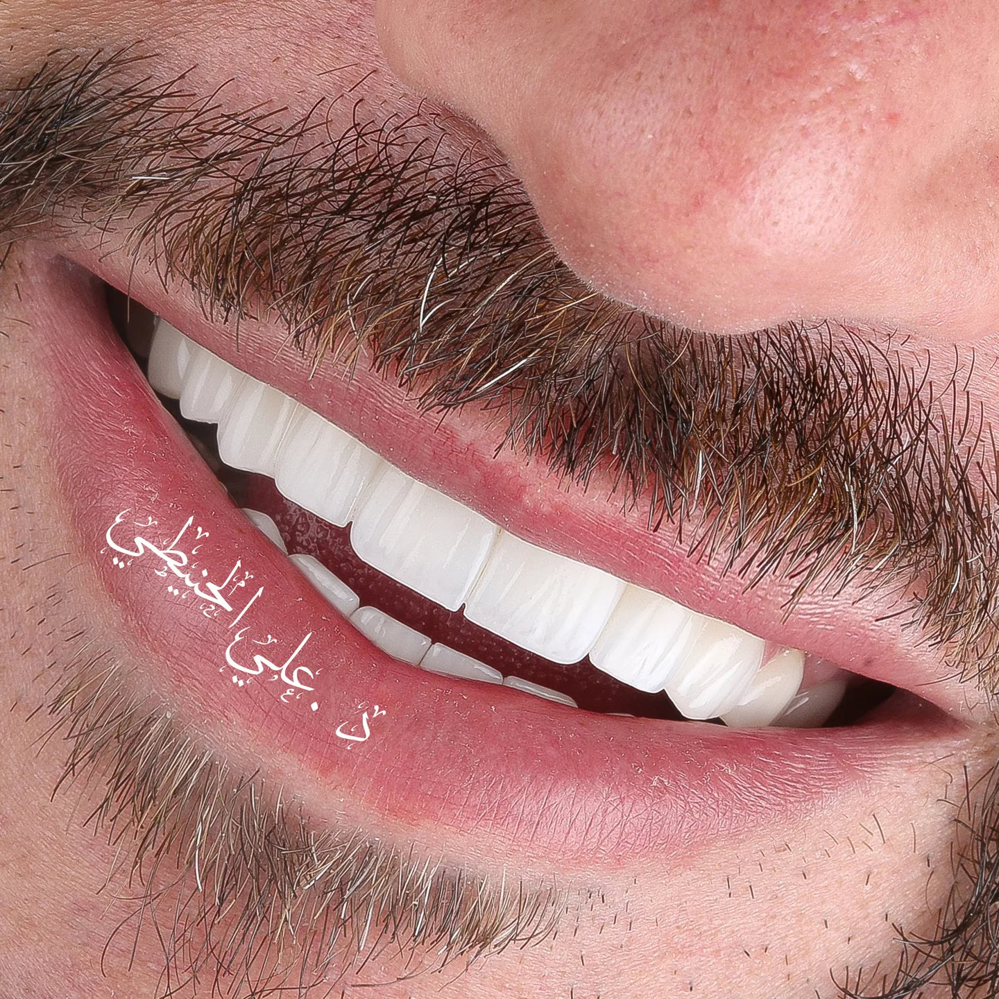 Dental veneers before and after smile result in Jordan 3