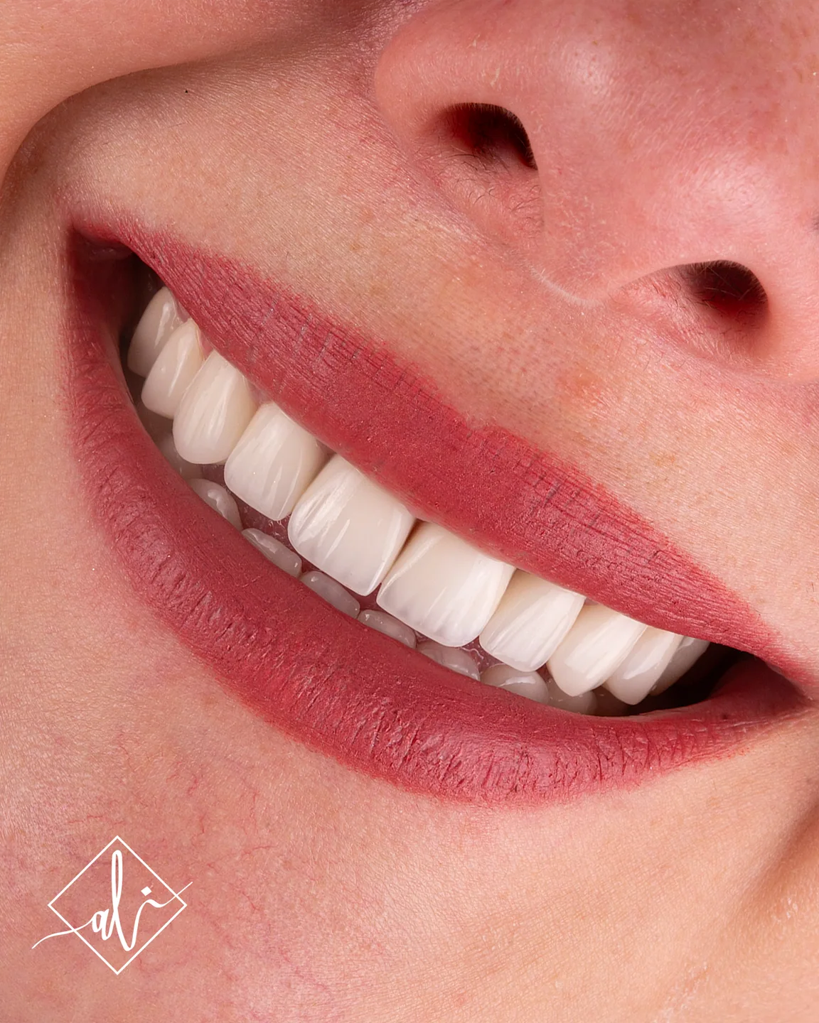 Soft white smile design transformation by Dr. Ali Al Heneiti 4