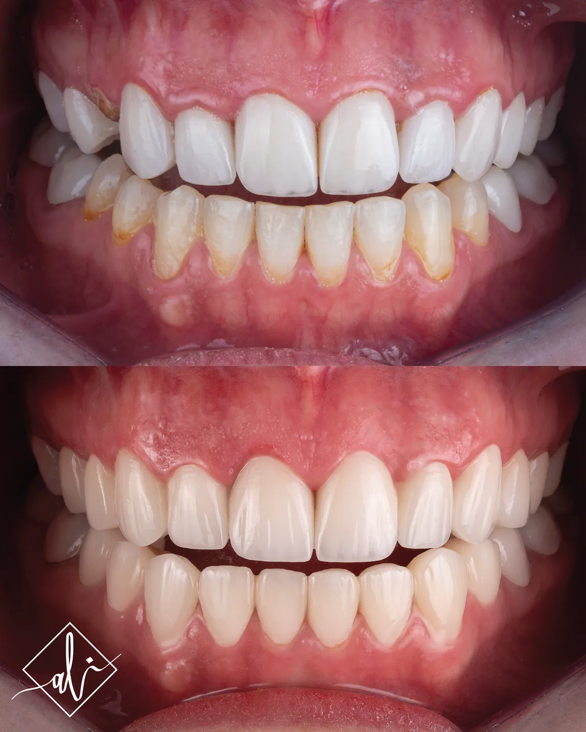 Soft white smile design transformation by Dr. Ali Al Heneiti 6