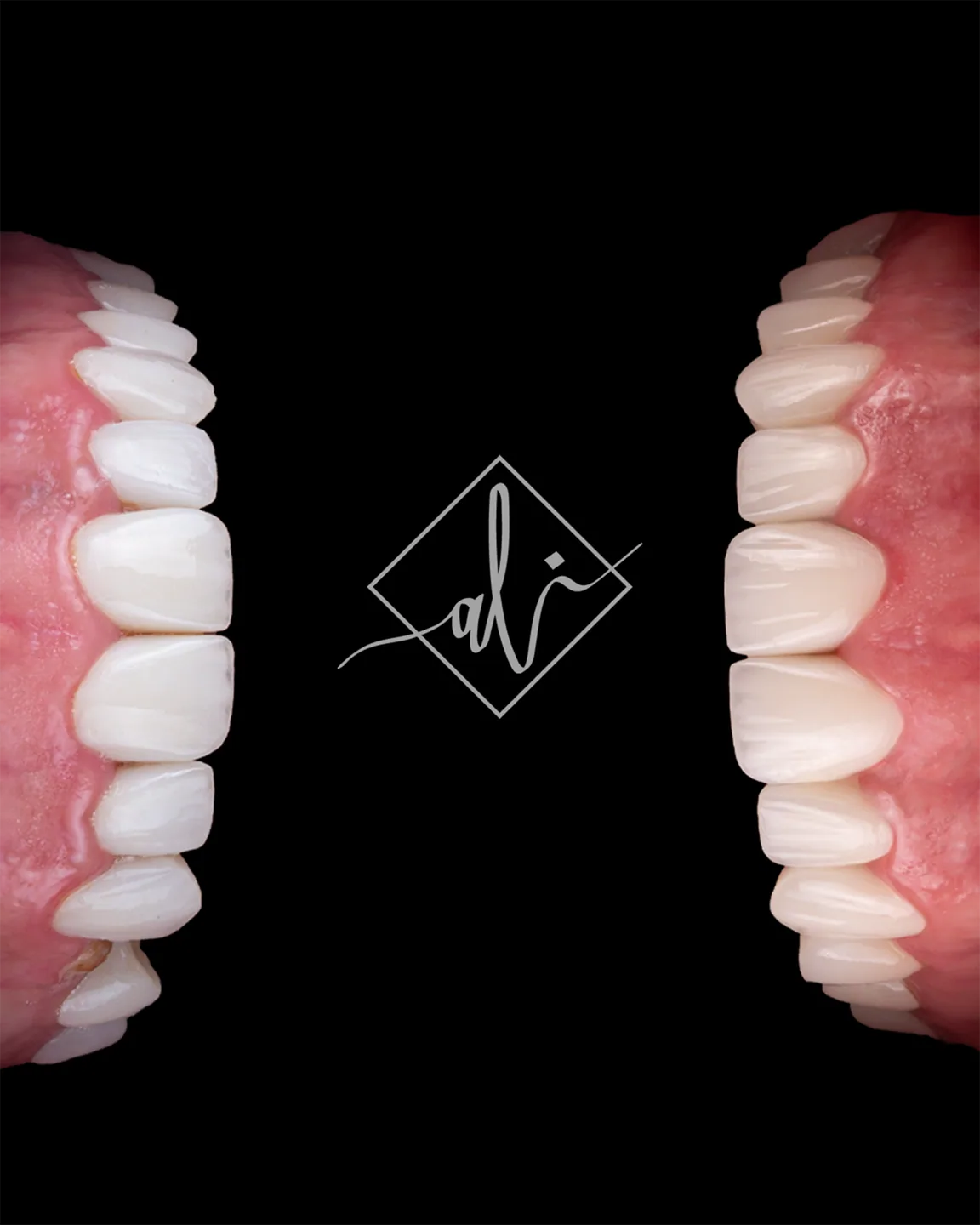 Soft white smile design transformation by Dr. Ali Al Heneiti 7