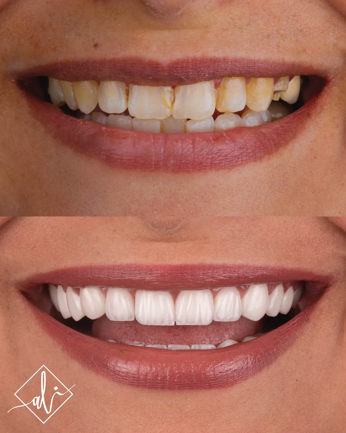 Elegant smile upgrade dental transformation in Amman 1