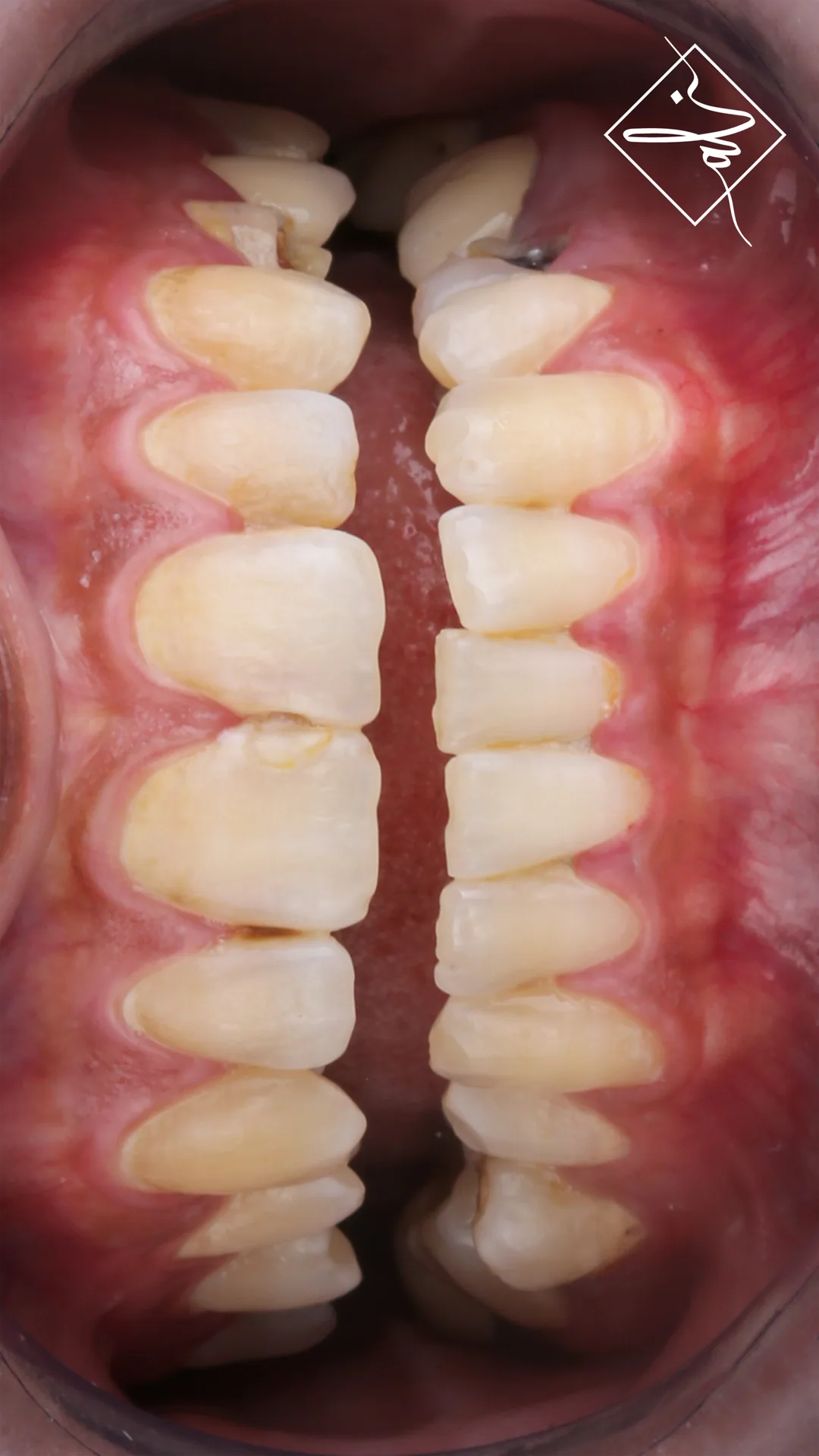 Elegant smile upgrade dental transformation in Amman 2