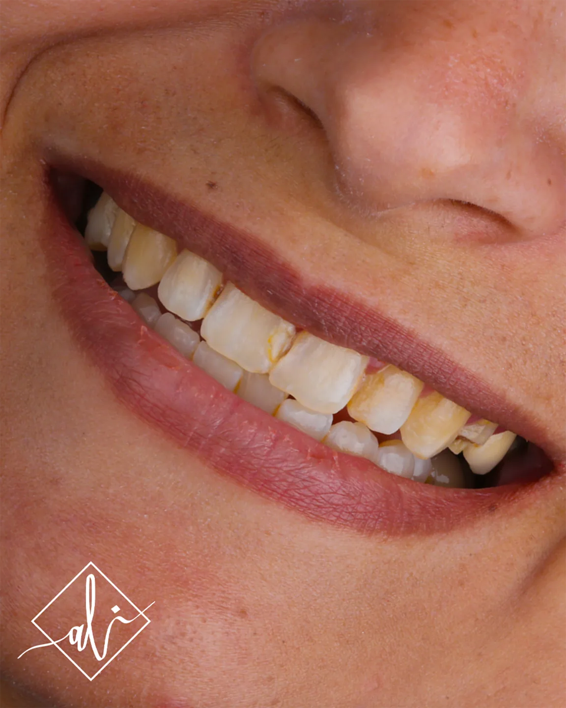 Elegant smile upgrade dental transformation in Amman 3