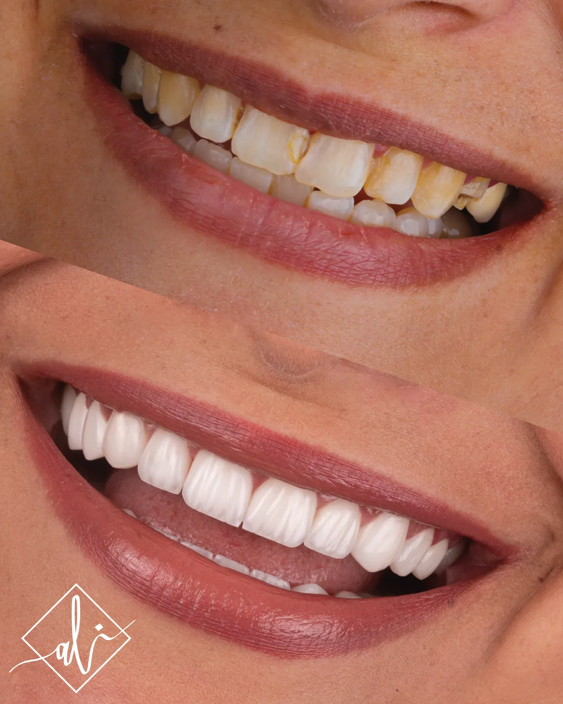 Elegant smile upgrade dental transformation in Amman 4