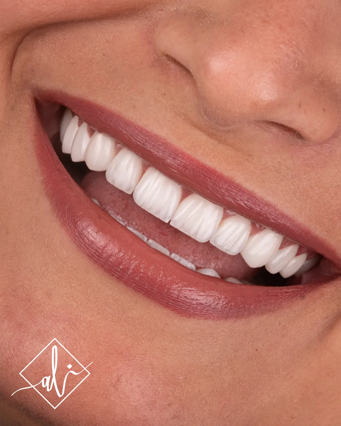 Elegant smile upgrade dental transformation in Amman 5