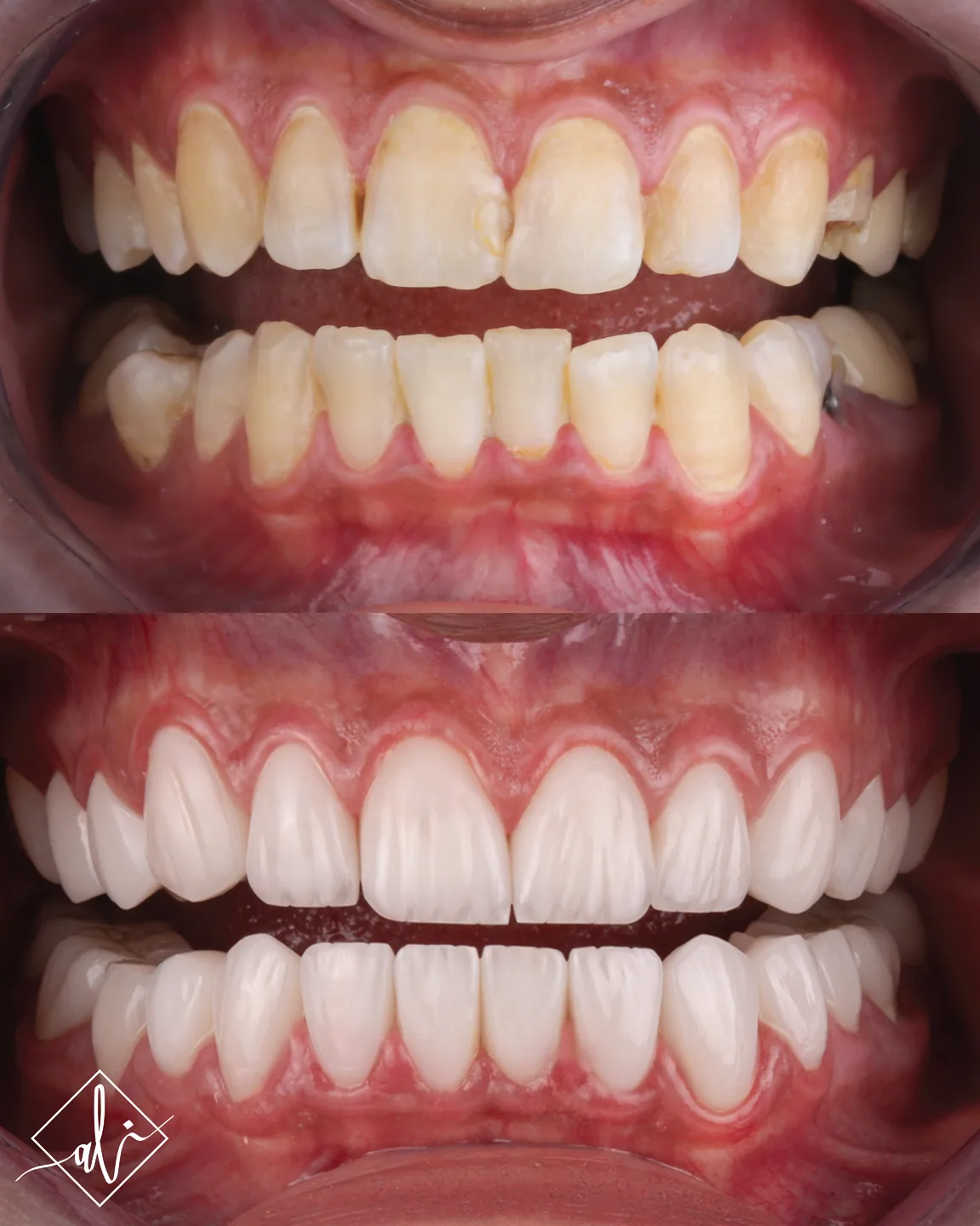 Elegant smile upgrade dental transformation in Amman 6