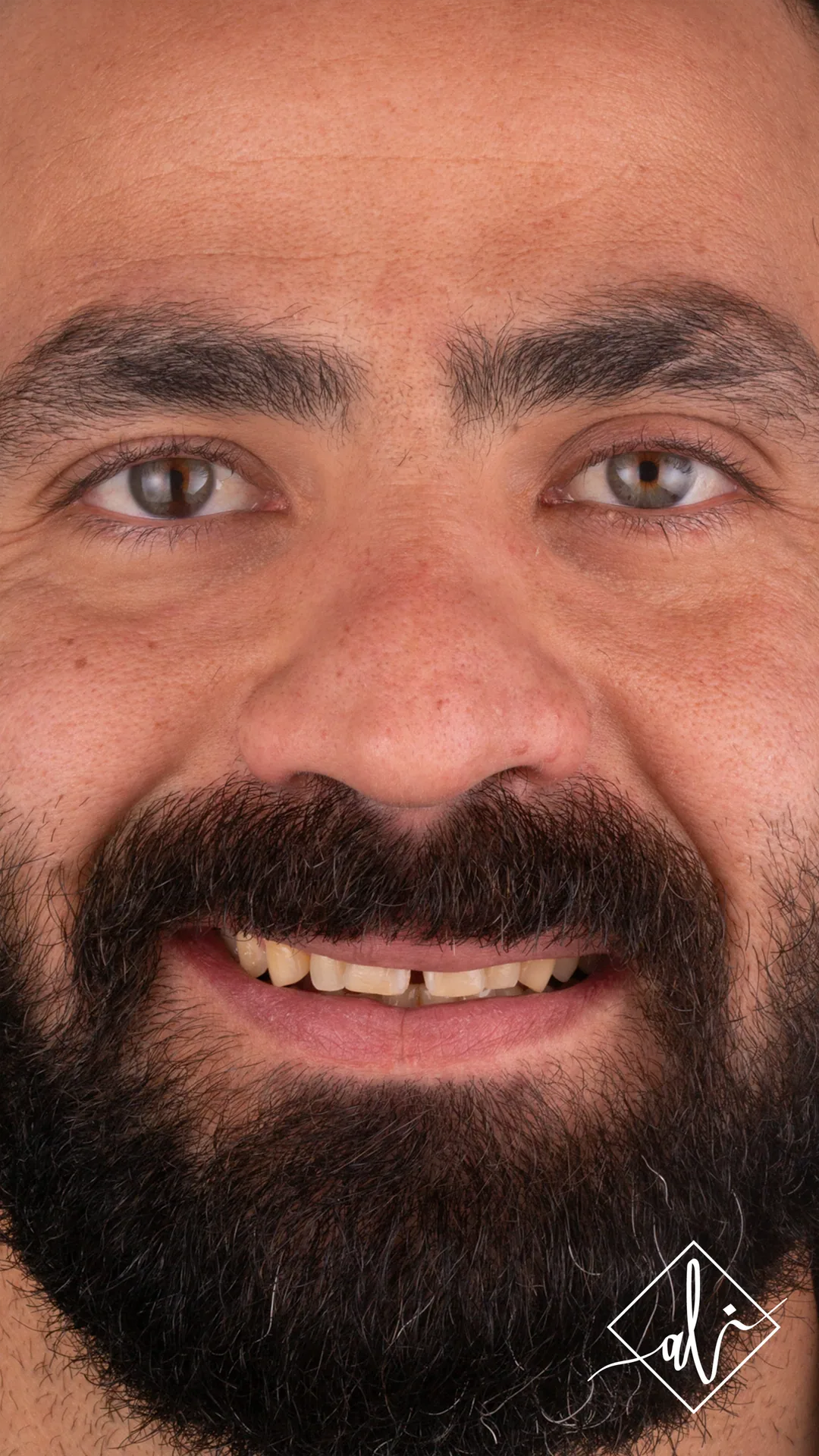 Dental smile design transformation by Dr. Ali Al Heneiti 1
