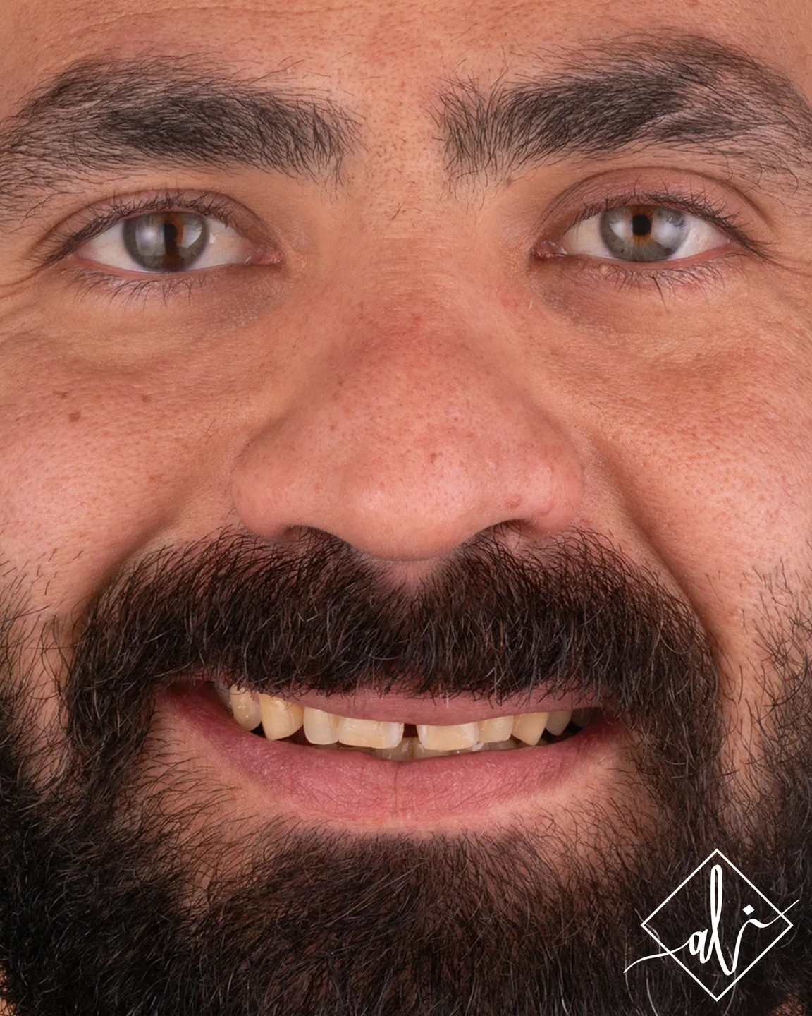 Dental smile design transformation by Dr. Ali Al Heneiti 3