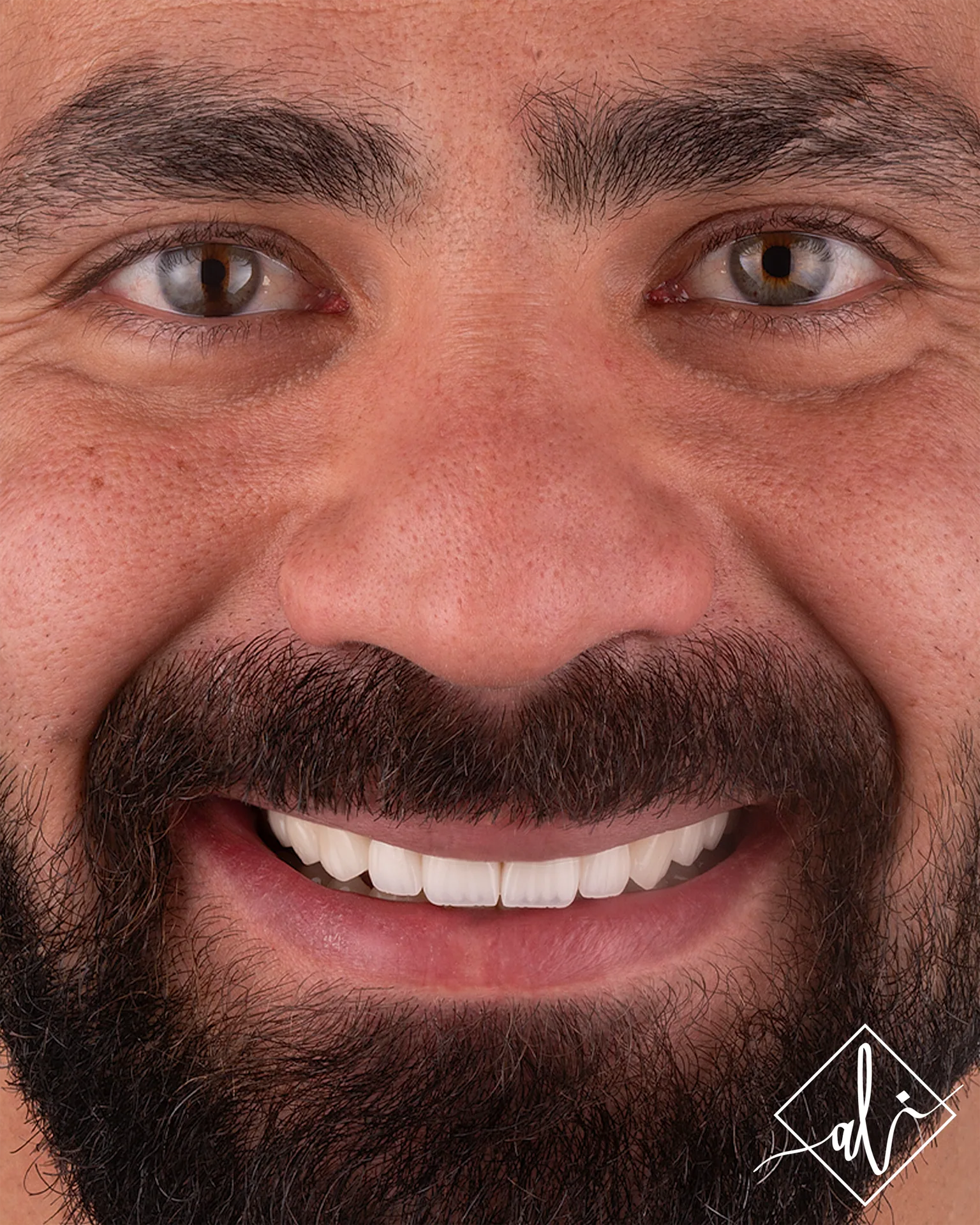 Dental smile design transformation by Dr. Ali Al Heneiti 4