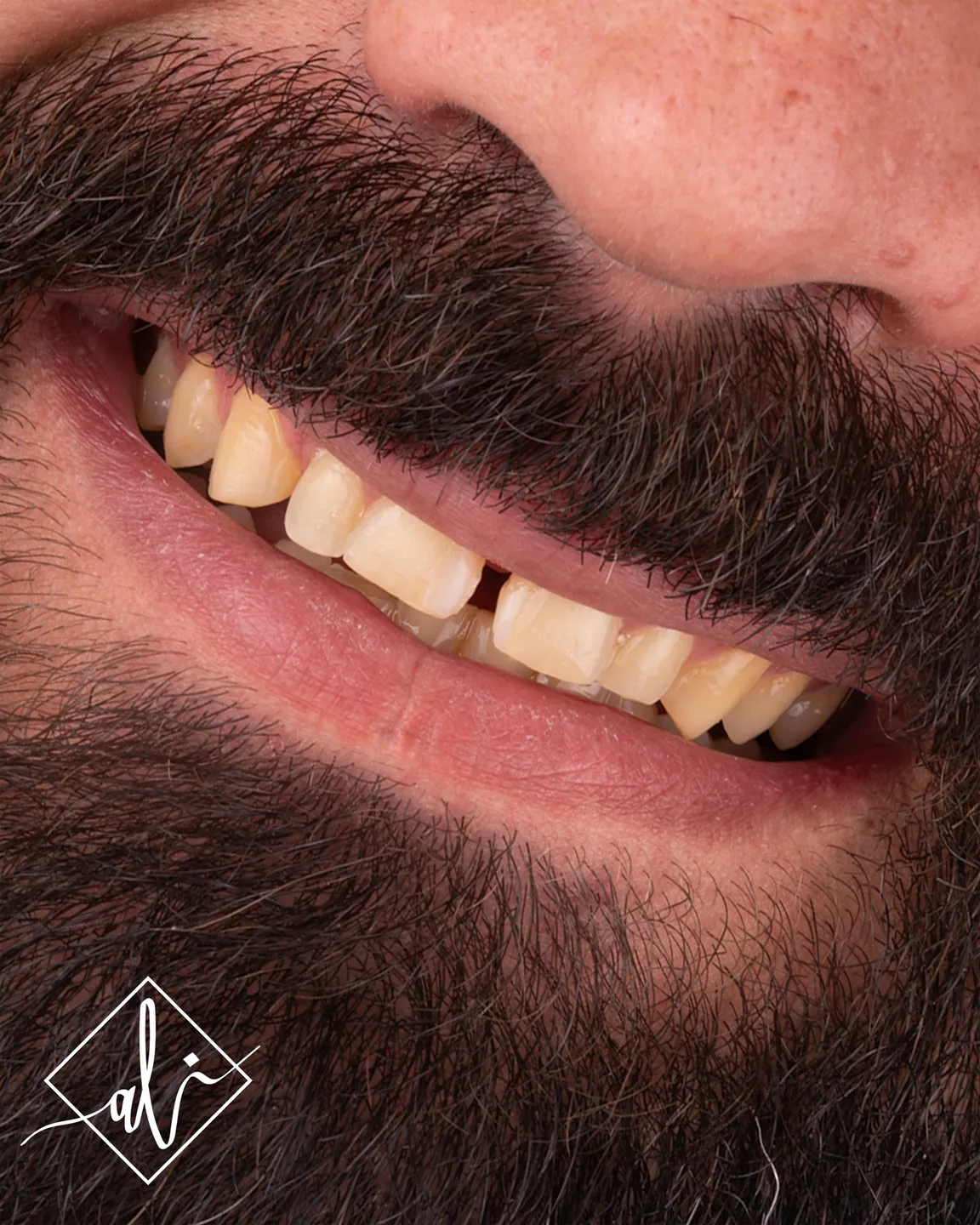 Dental smile design transformation by Dr. Ali Al Heneiti 5