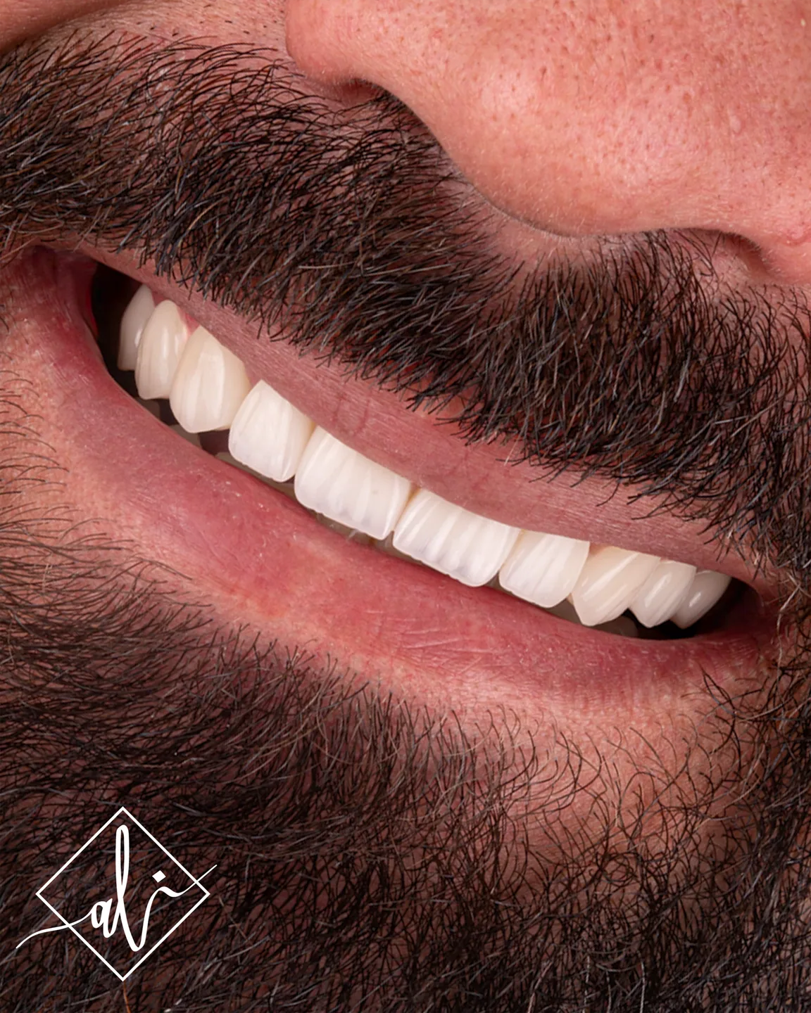 Dental smile design transformation by Dr. Ali Al Heneiti 6
