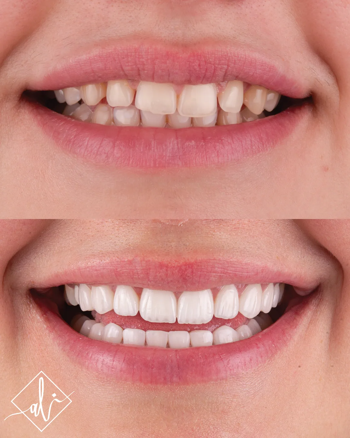 Confident smile transformation before and after in Amman 1