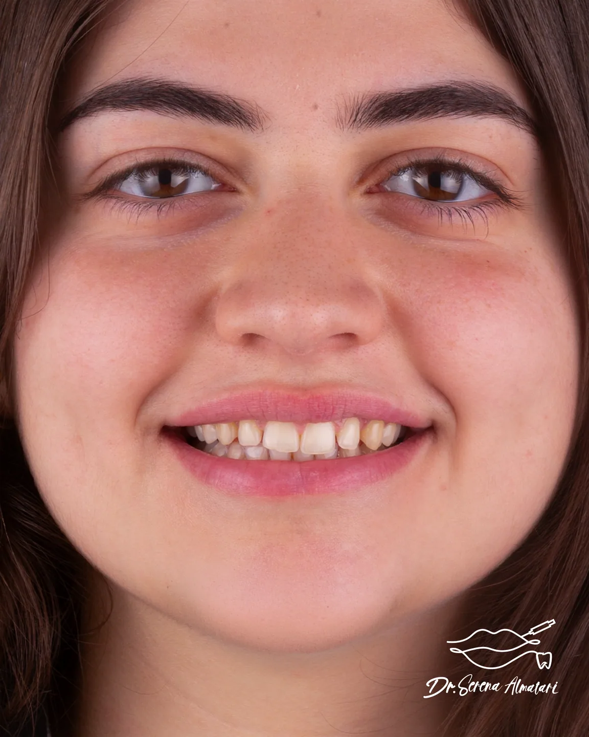 Confident smile transformation before and after in Amman 2