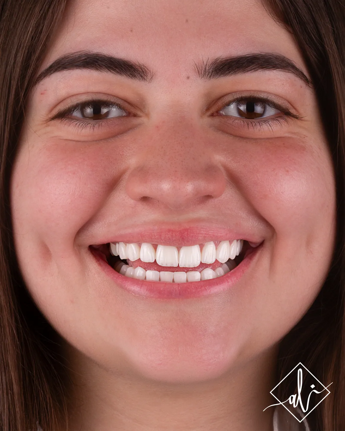 Confident smile transformation before and after in Amman 3