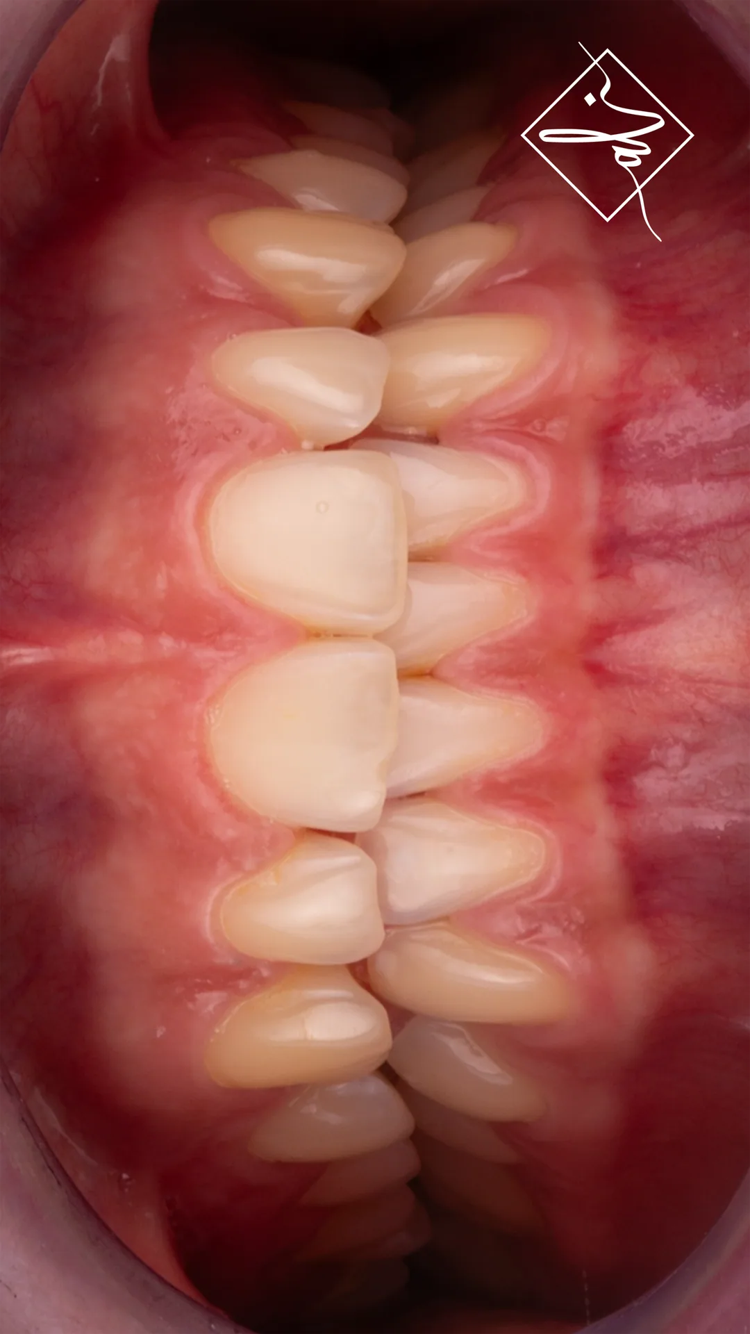 Confident smile transformation before and after in Amman 4