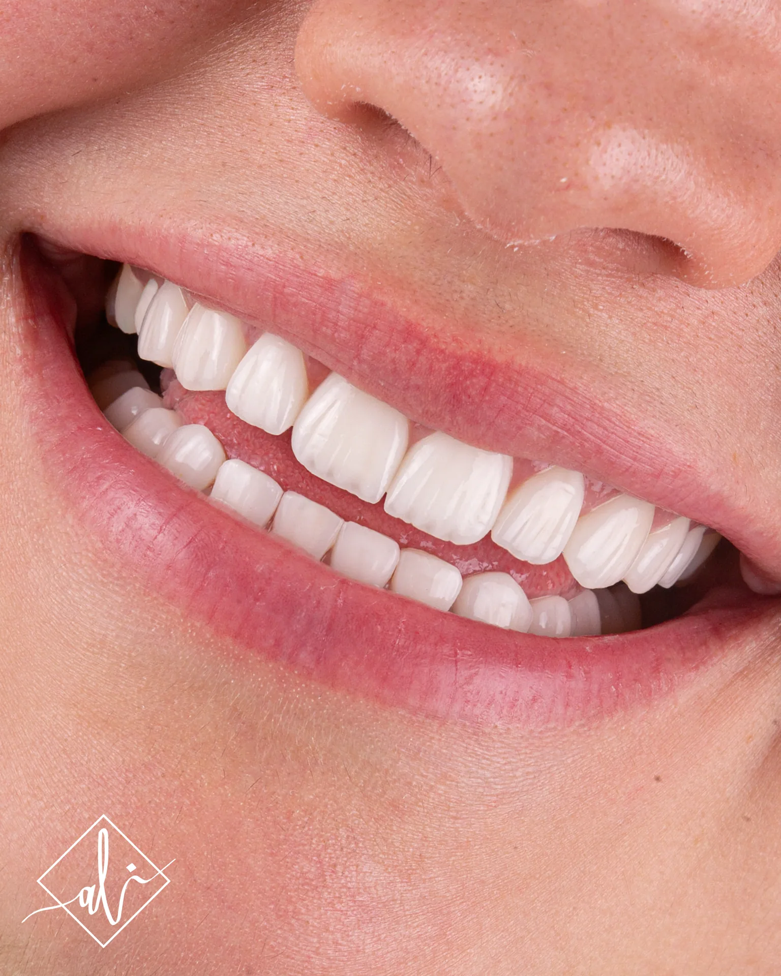 Confident smile transformation before and after in Amman 5