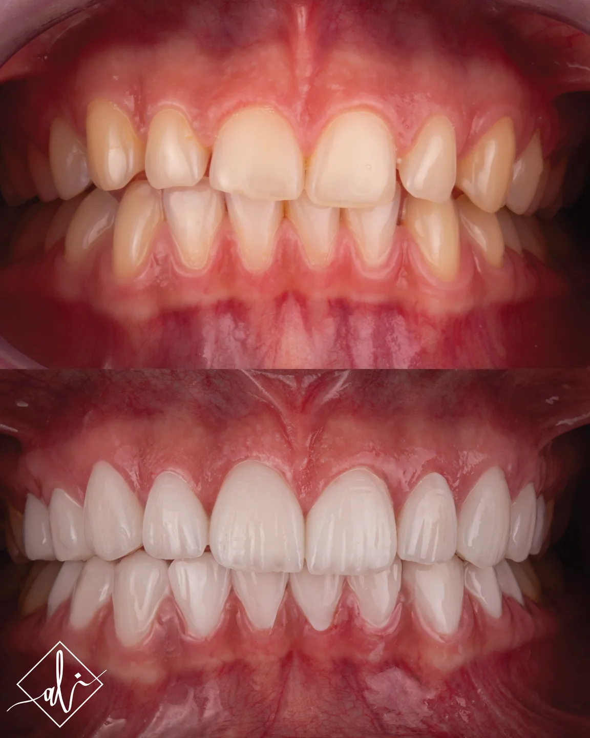 Confident smile transformation before and after in Amman 6