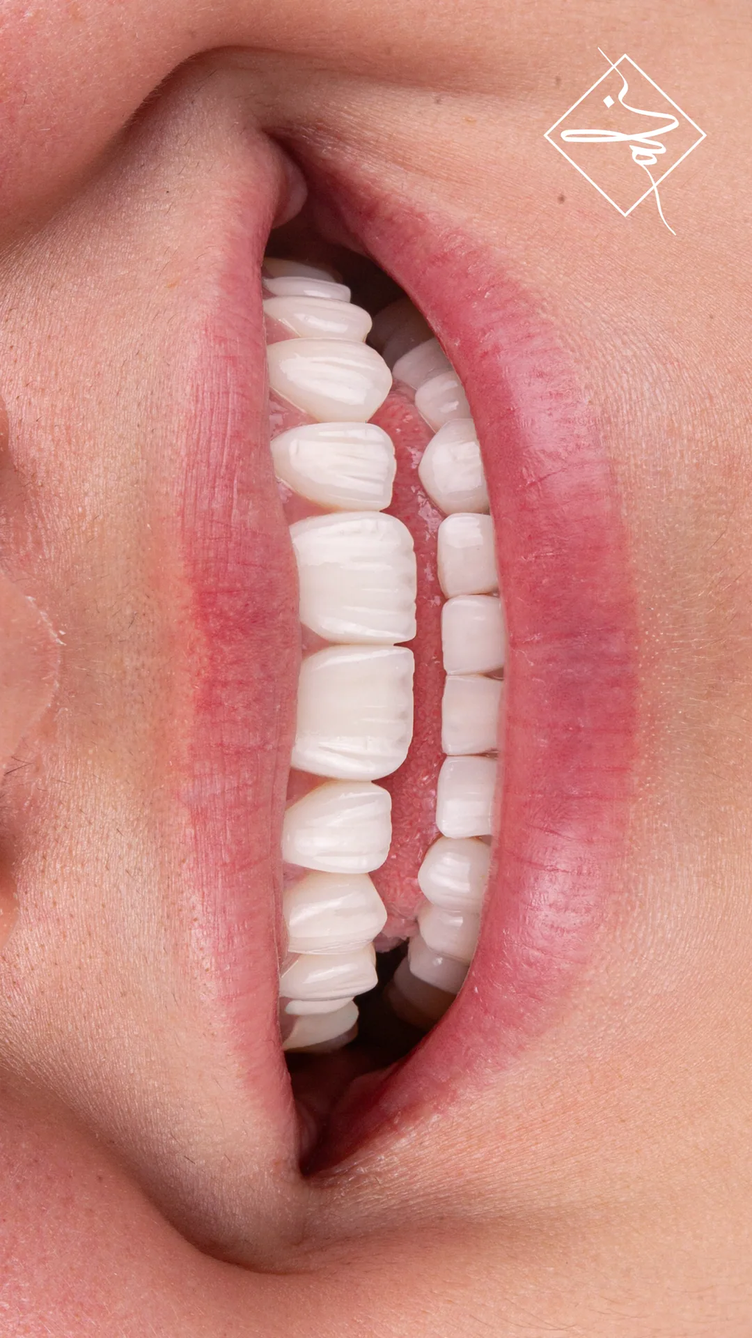 Confident smile transformation before and after in Amman 7