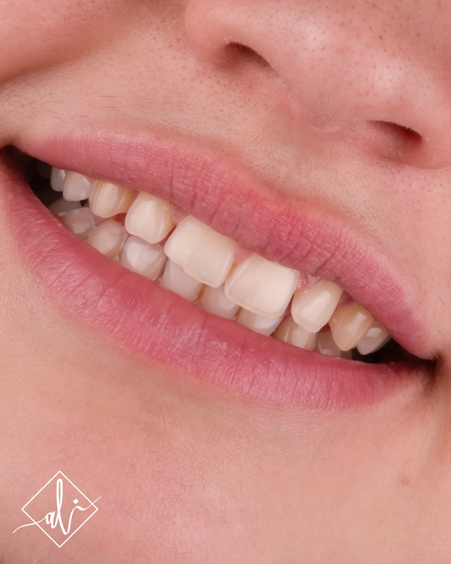 Confident smile transformation before and after in Amman 8