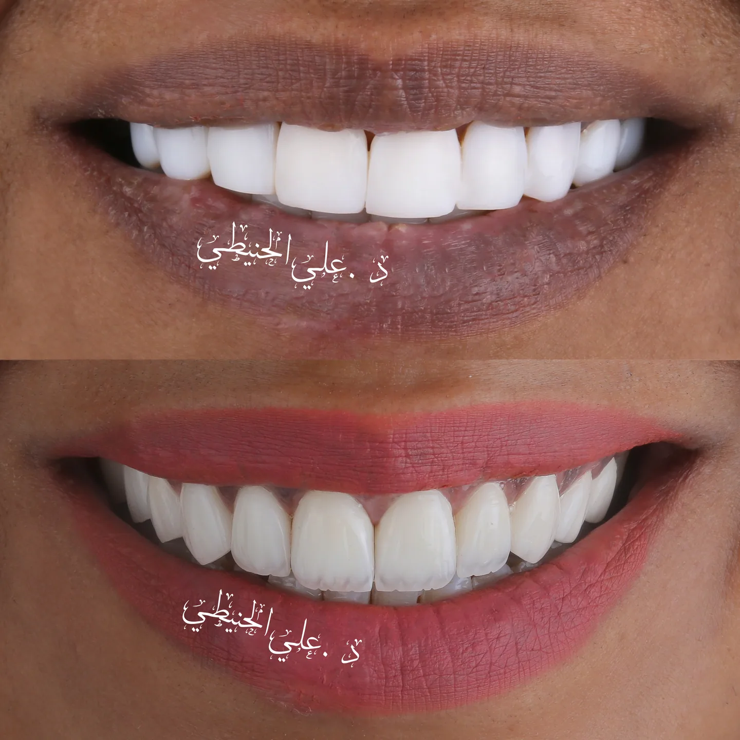 Refined veneers smile transformation in Jordan 1