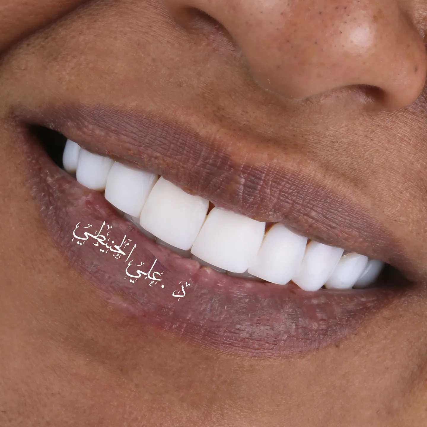 Refined veneers smile transformation in Jordan 2