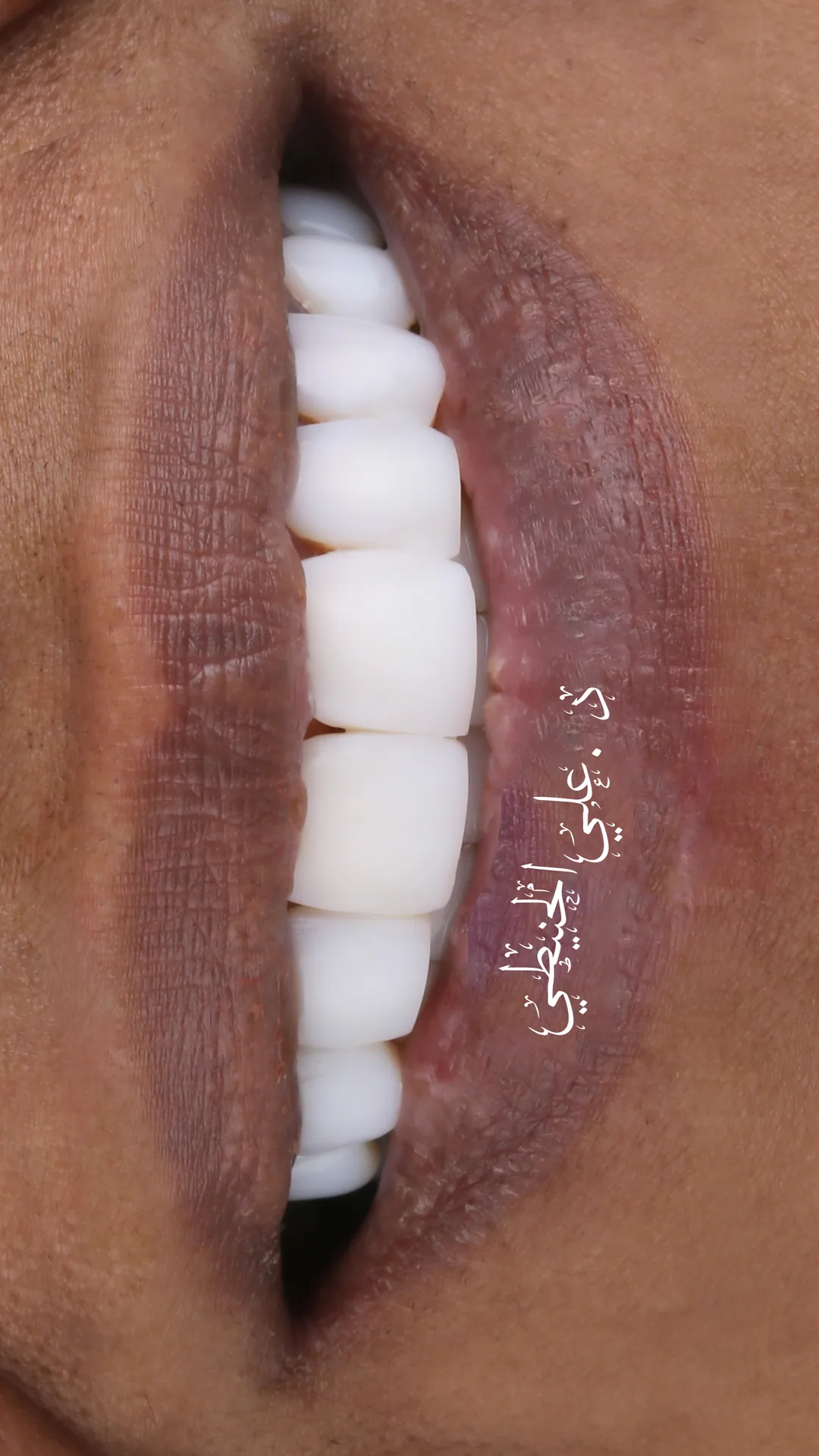 Refined veneers smile transformation in Jordan 3