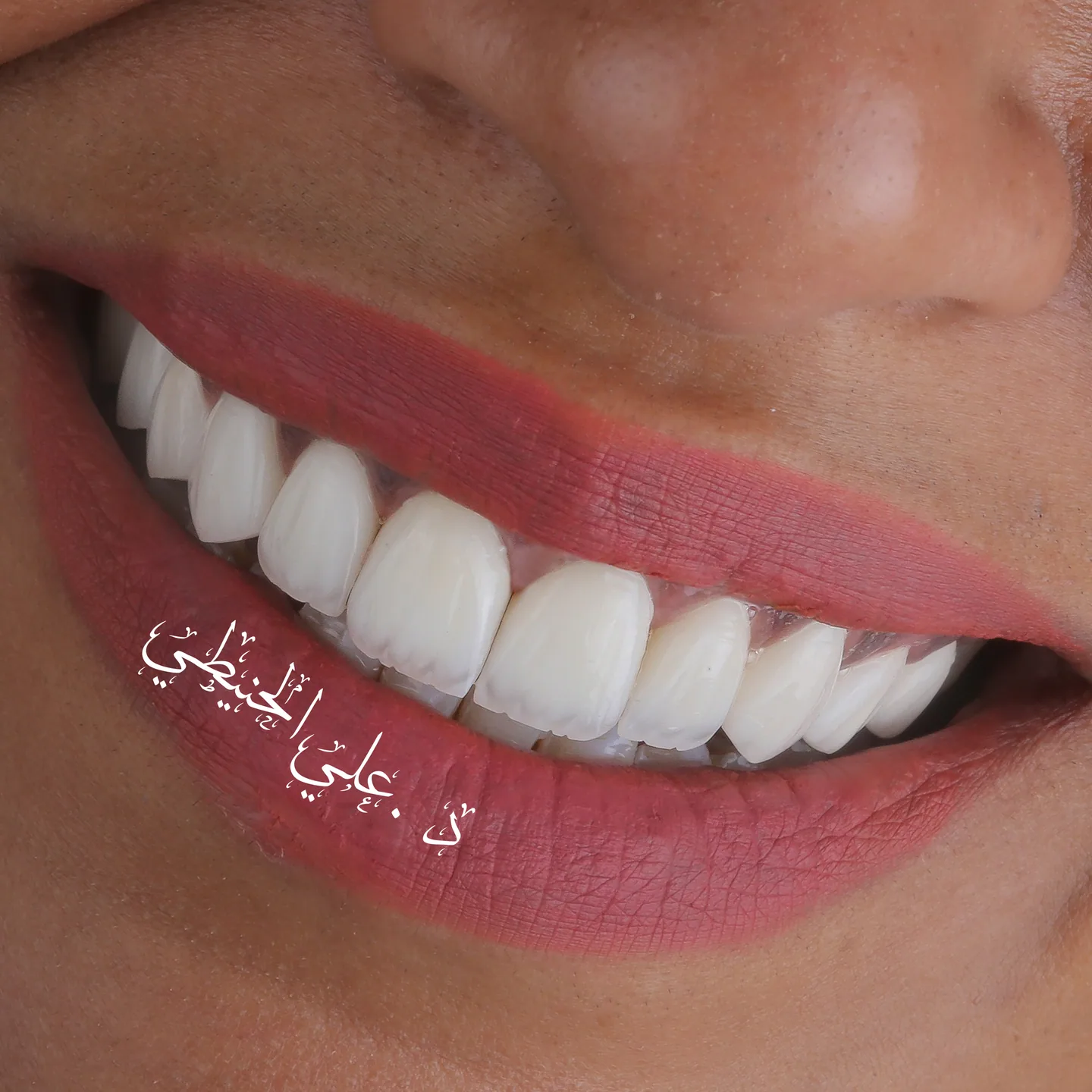 Refined veneers smile transformation in Jordan 4