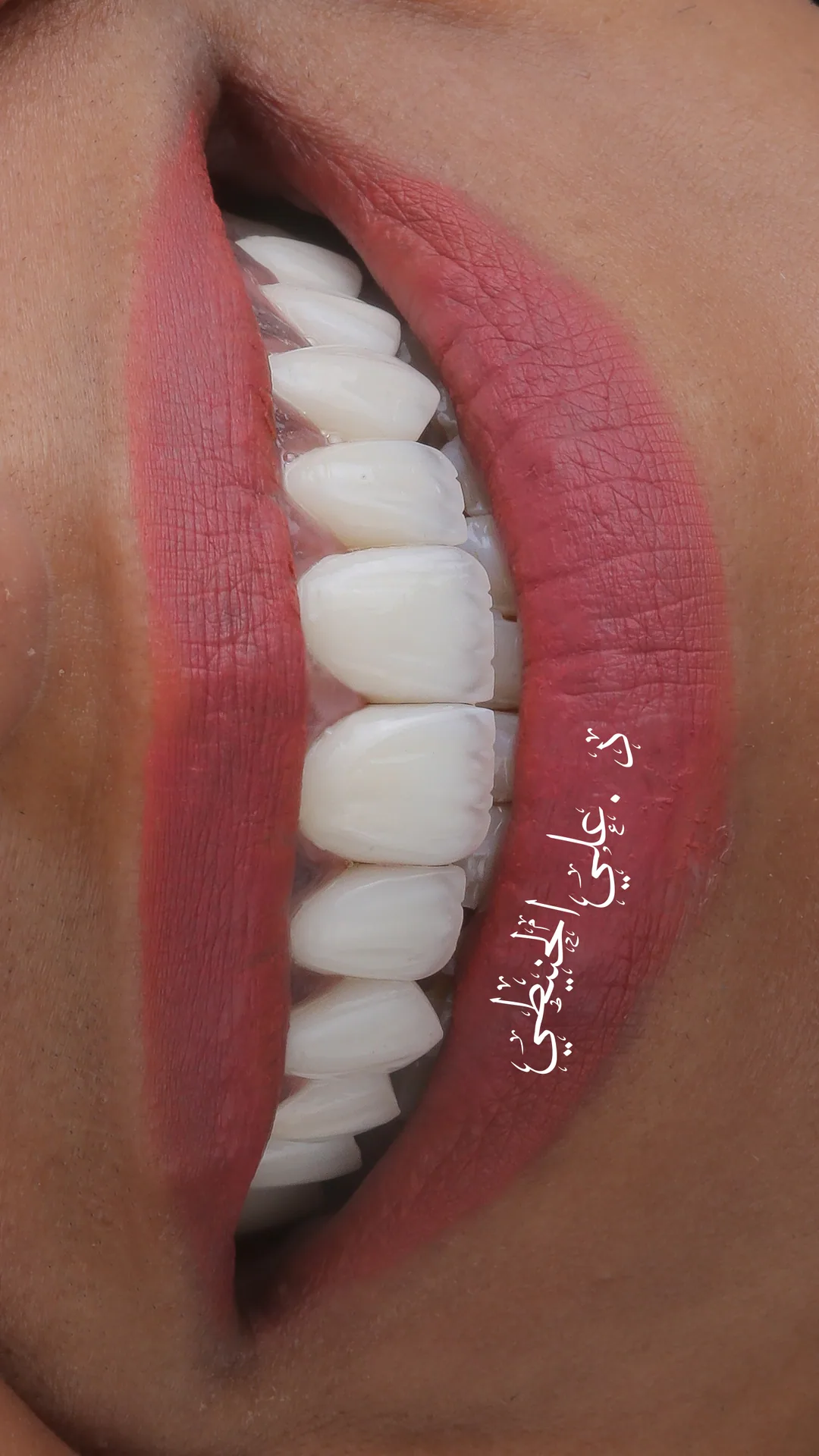 Refined veneers smile transformation in Jordan 5