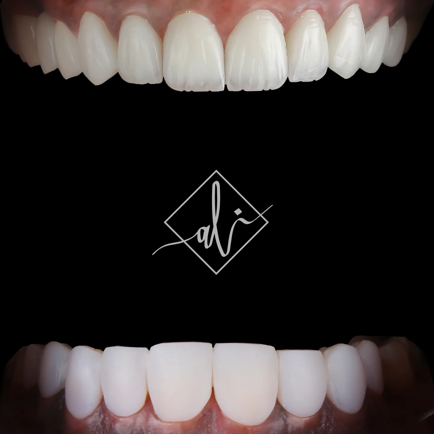 Refined veneers smile transformation in Jordan 6