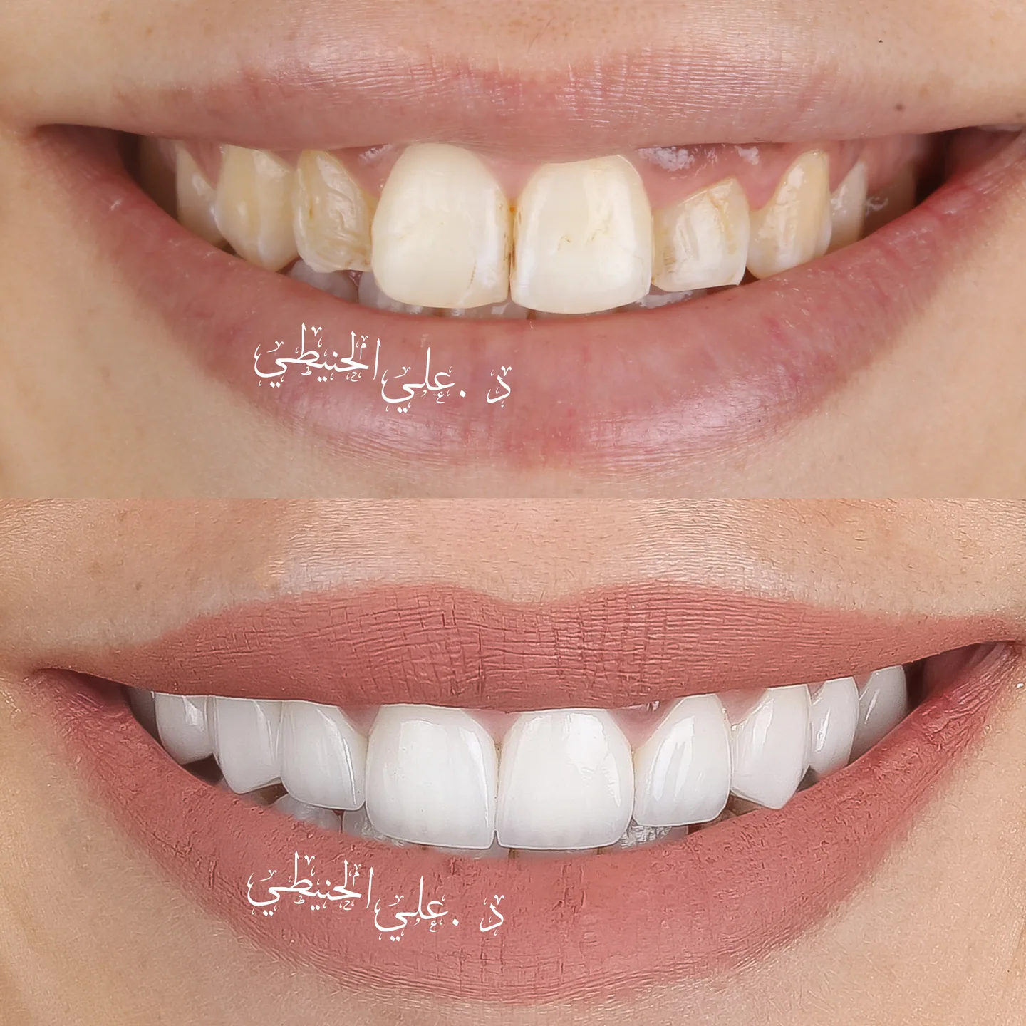 Natural smile upgrade before and after dental result 1